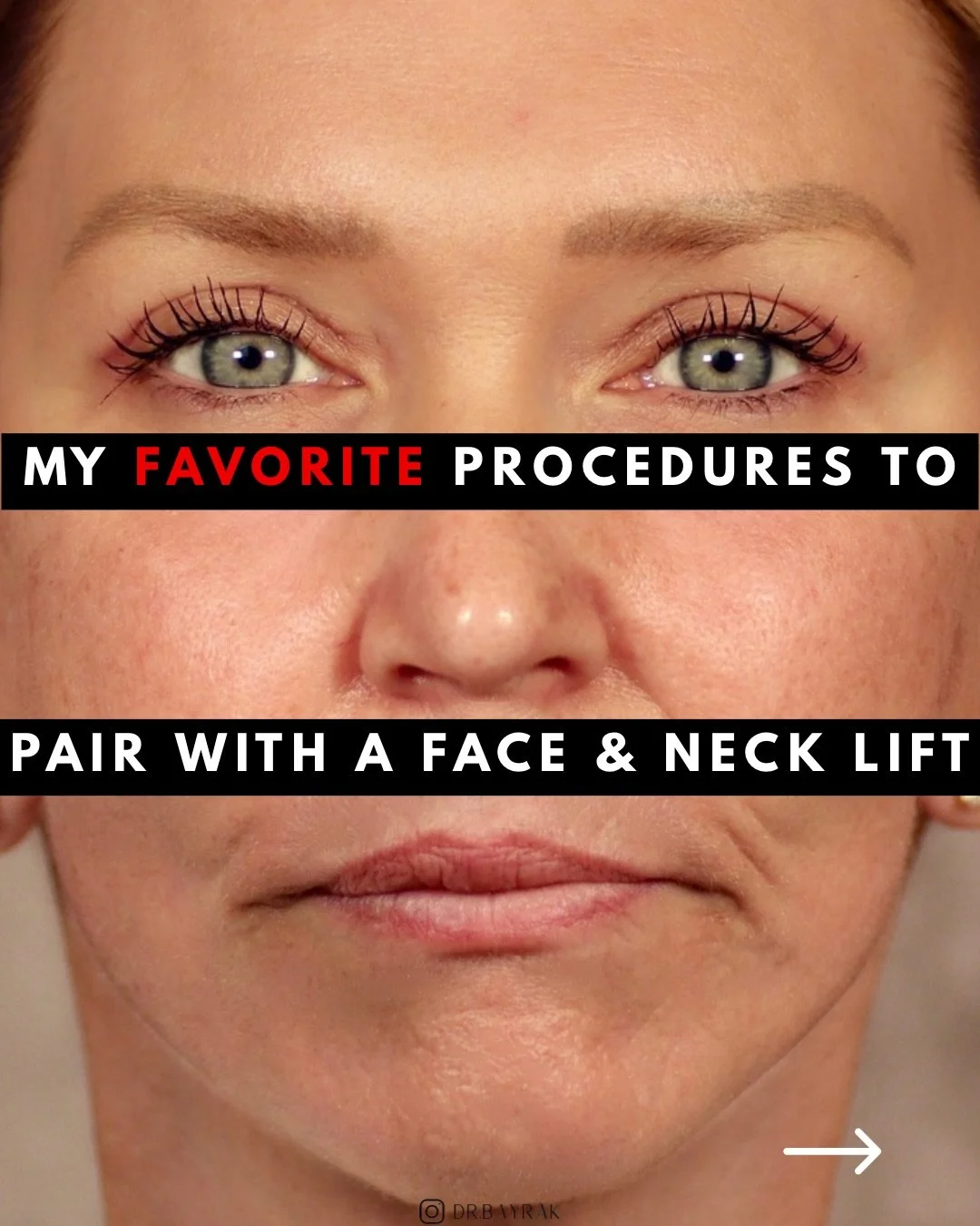 A facelift repositions and tightens. But skin quality, volume loss, and upper eyelid heaviness are separate problems that require separate solutions. That&rsquo;s why I commonly combine facelifts with CO2 laser resurfacing, facial fat transfer, and u