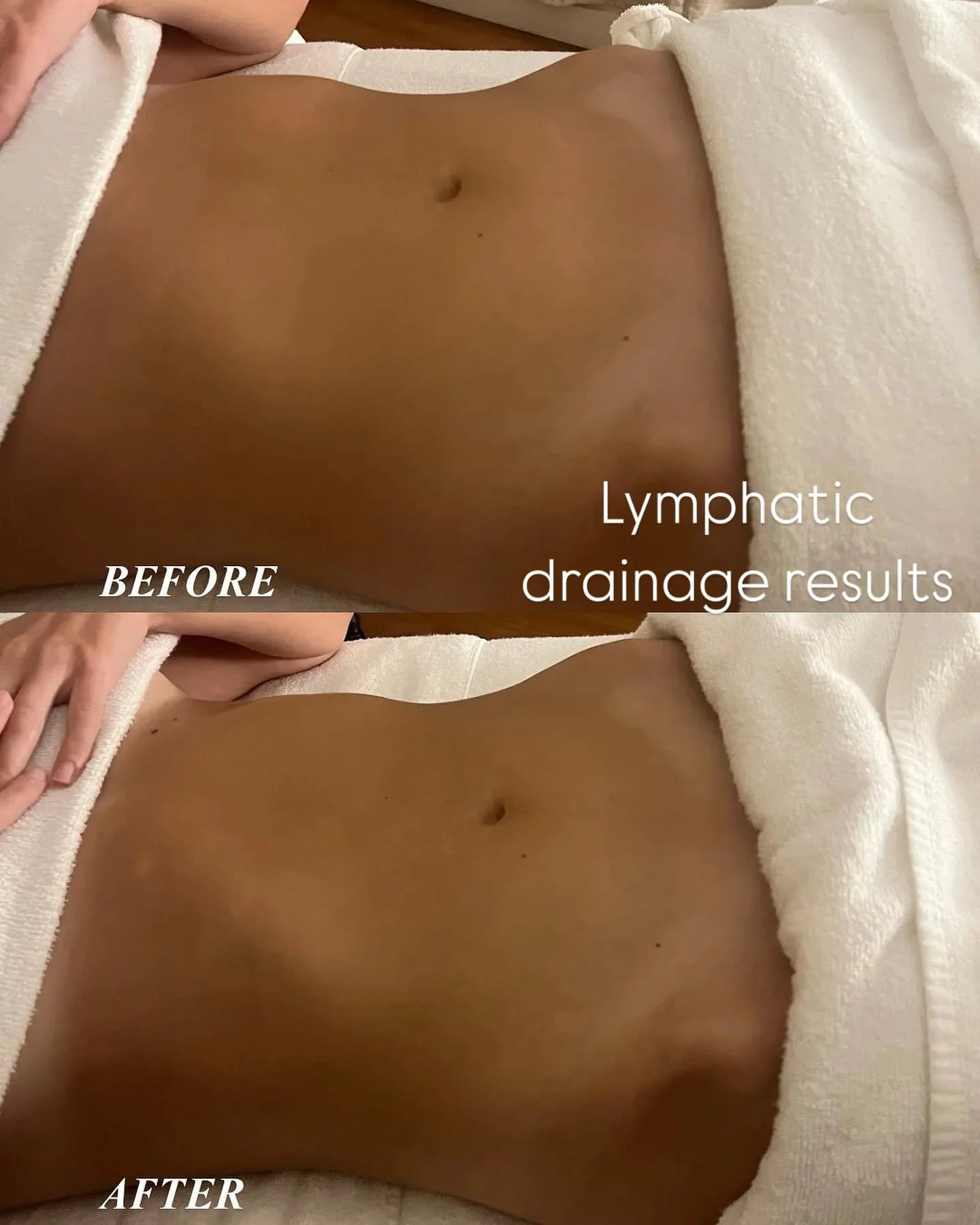 ✨ Transformative Results! ✨

Check out this amazing before and after from just one session of lymphatic drainage therapy! 🌟 The reduction in fluid retention is incredible, showcasing how effective this treatment can be for enhancing overall wellness