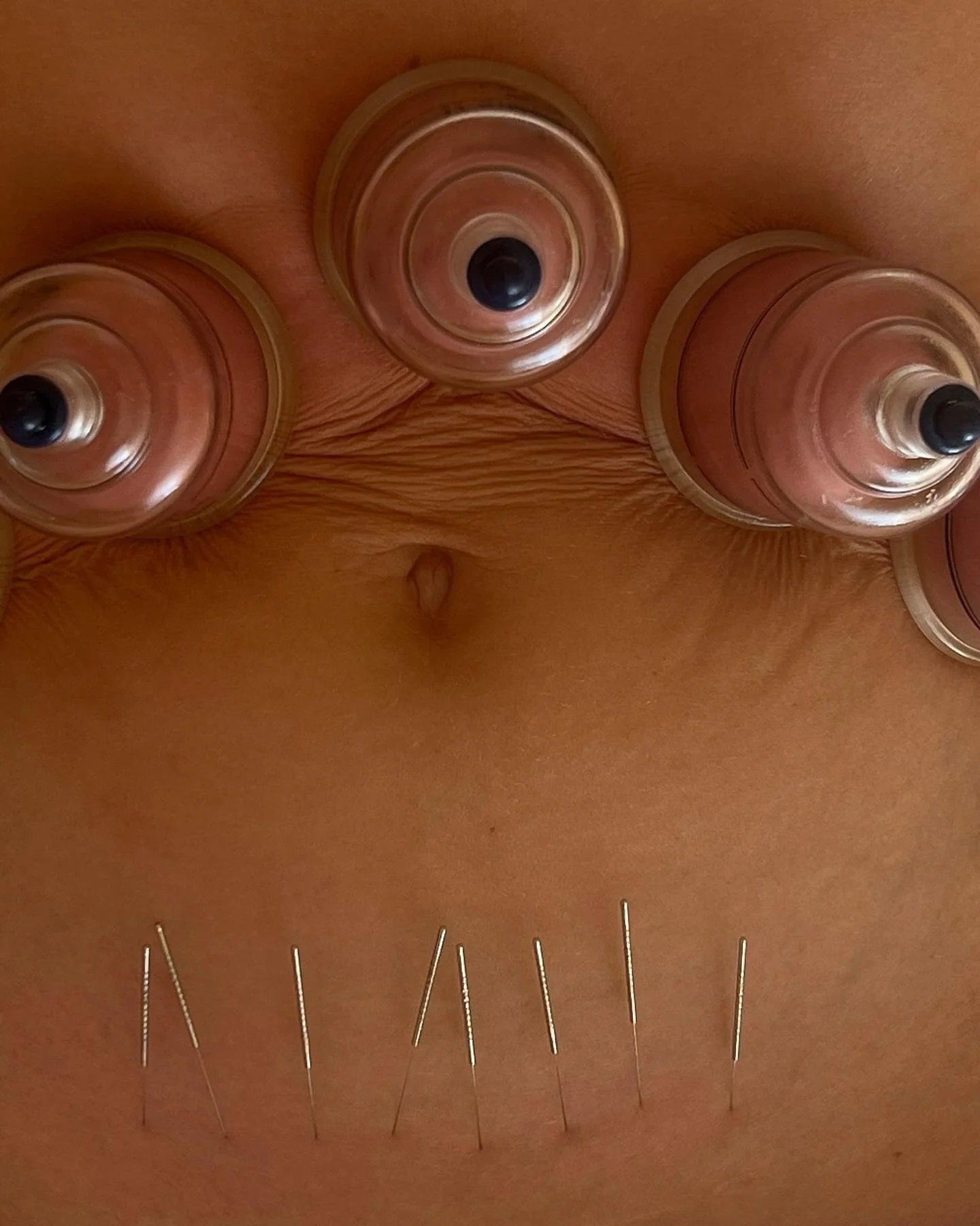 Cupping therapy, when combined with remedial massage, offers powerful benefits. The suction created by cupping helps to increase blood flow, release deep-seated tension, and promote faster healing. This ancient technique enhances the effects of remed