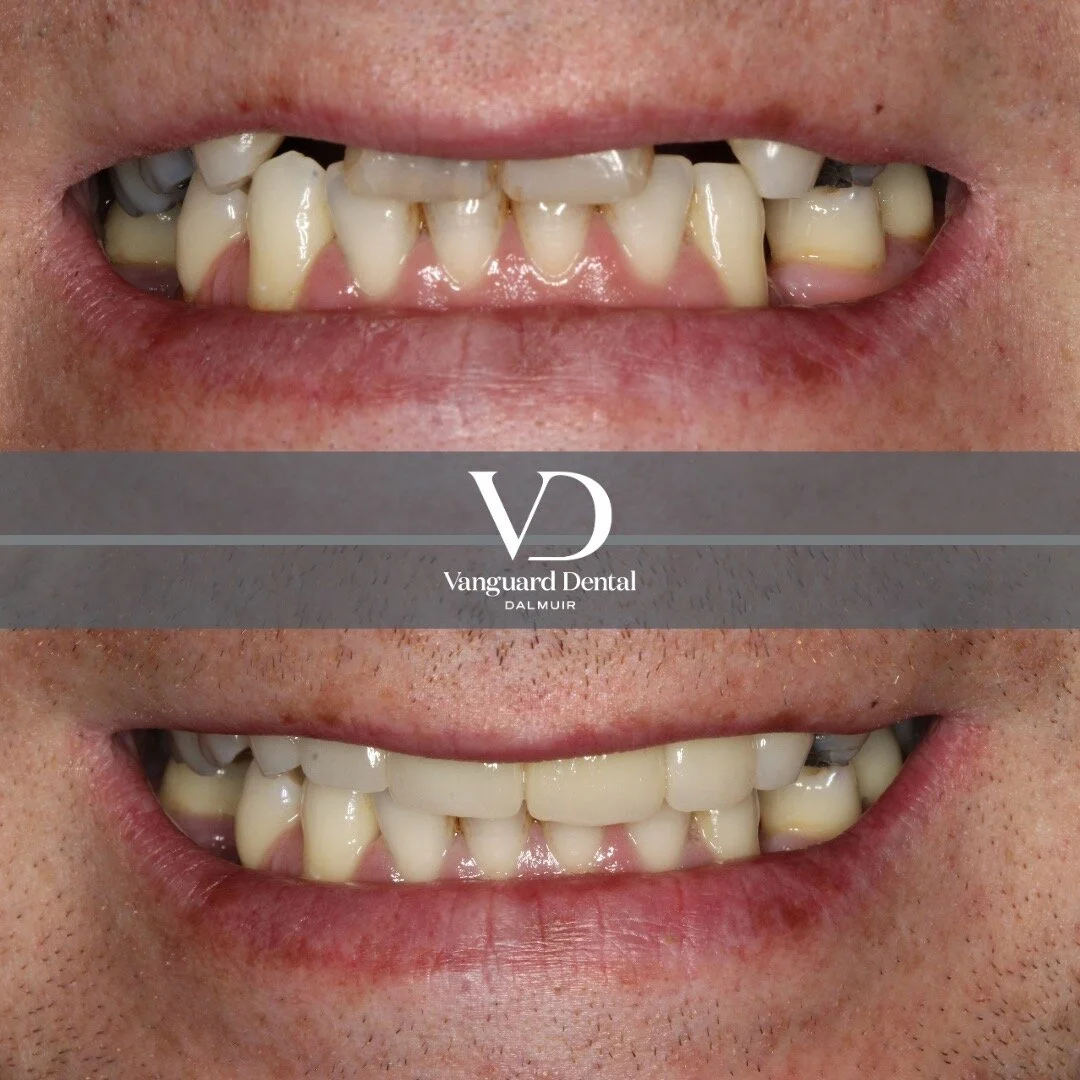 This case here the patient was fed up with his partial denture that replaced his two teeth missing at the front. He was very self conscious and rarely smiled. He had to take his denture out to eat and hated that is moved when he talked and was out fo