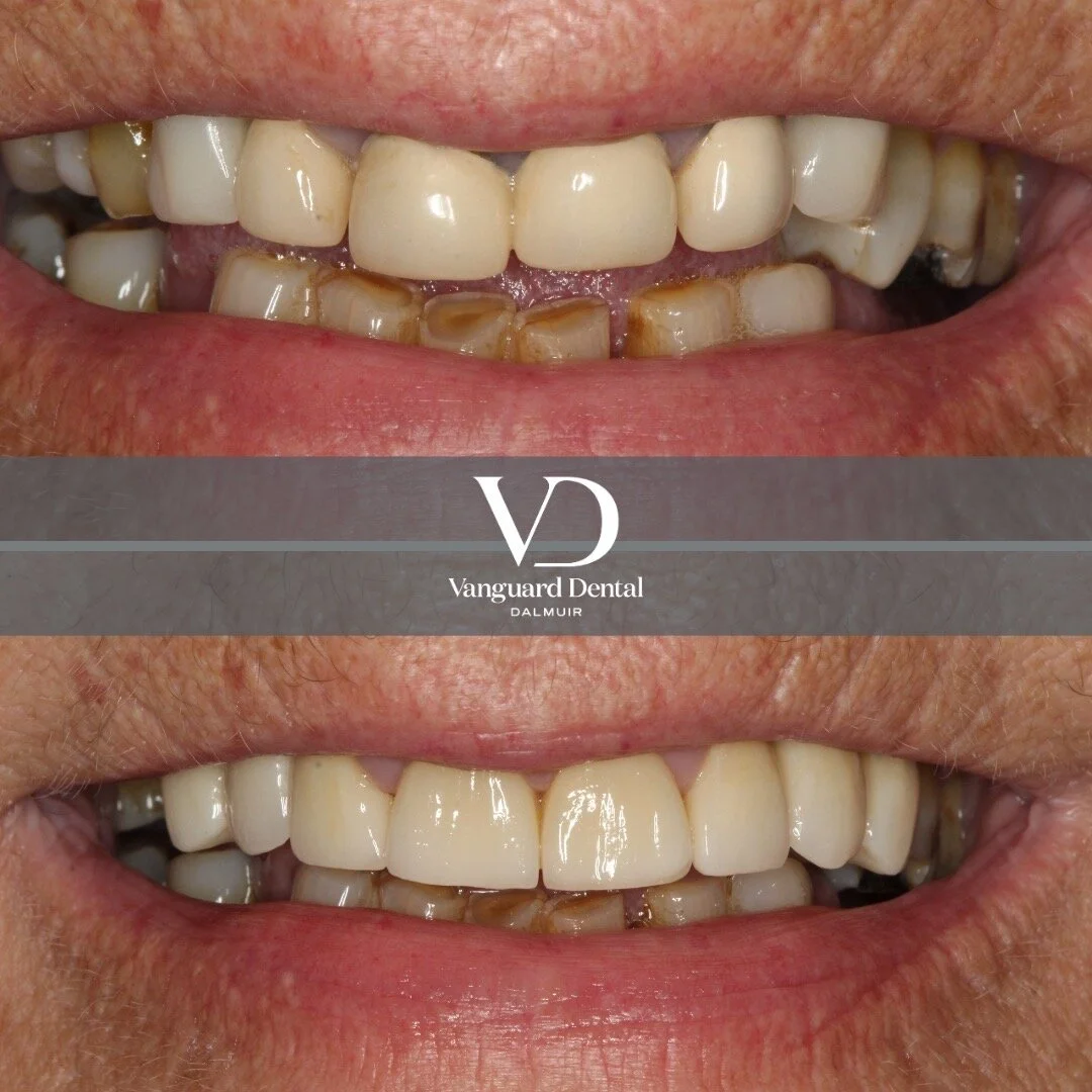 Say no to single tooth dentistry! 
This lovely patient was fed up with her teeth not looking straight and grey metal showing above her crowns. She wore a small partial denture to replace 2 teeth adding to the uneven appearance between the porcelain c