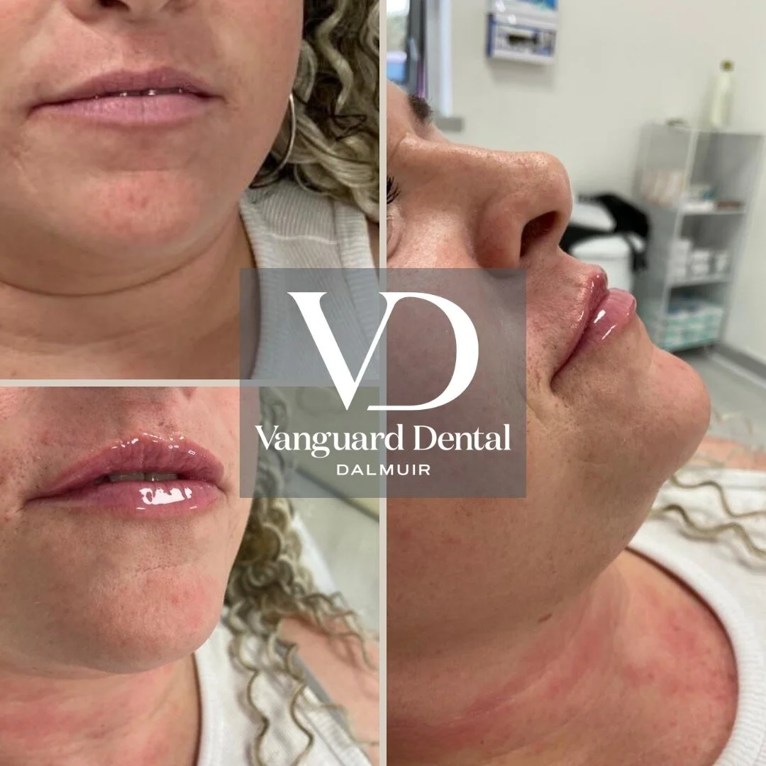 ✨ Subtle Transformation: Before &amp; After with Dermal Fillers! 🌟 

Witness the artistry of discrete and natural-looking aesthetics at Vanguard Dental:

📸 Before:
In the before image, a canvas awaiting a touch of refinement. Natural features are e