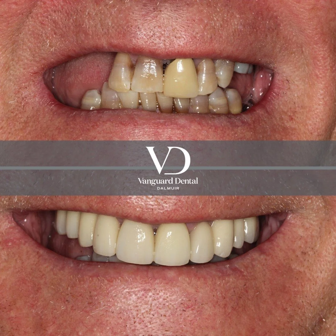 Upper arch rehabilitation 

Fantastic result for a fantastic patient! 

Through careful planning and close communication with the dental lab we fully restored this patients upper arch.

Here we used implants to replace his missing teeth and a combina