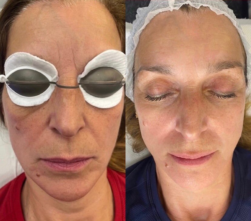 🪽S K I N R E J U V E N A T I O N 🪽

What a transformation! This lovely client wanted to focus on her frown lines, eye bags and lifting the area around her mouth and chin! She joined the membership for 6 months and was able to have 2 facials a month
