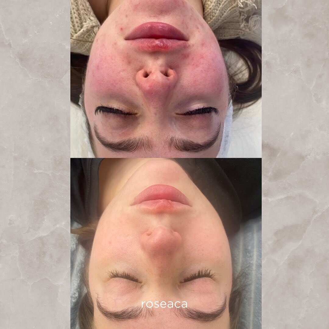 🚩 R O S E A C A 🚩 

Did you know regular laser facials can help to clear roseaca?! 

A course of laser facials designed to alleviate rosacea concerns. With precision and expertise, our treatments safely use powerful @allwhitelaser medical grade las