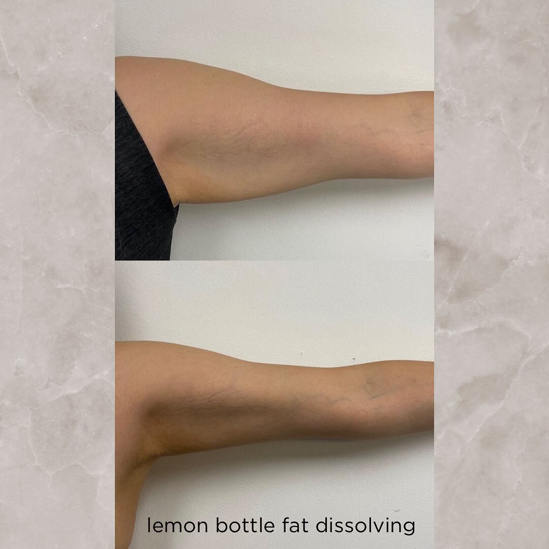 🍋🍋 L E M O N B O T T L E 🍋🍋

Small area - &pound;120
Medium area - &pound;160
Large area - &pound;200

This is the result of just ONE TREATMENT on the arms photos taken three weeks apart.
With a combination of Riboflavin (vitamin B2) and quality,