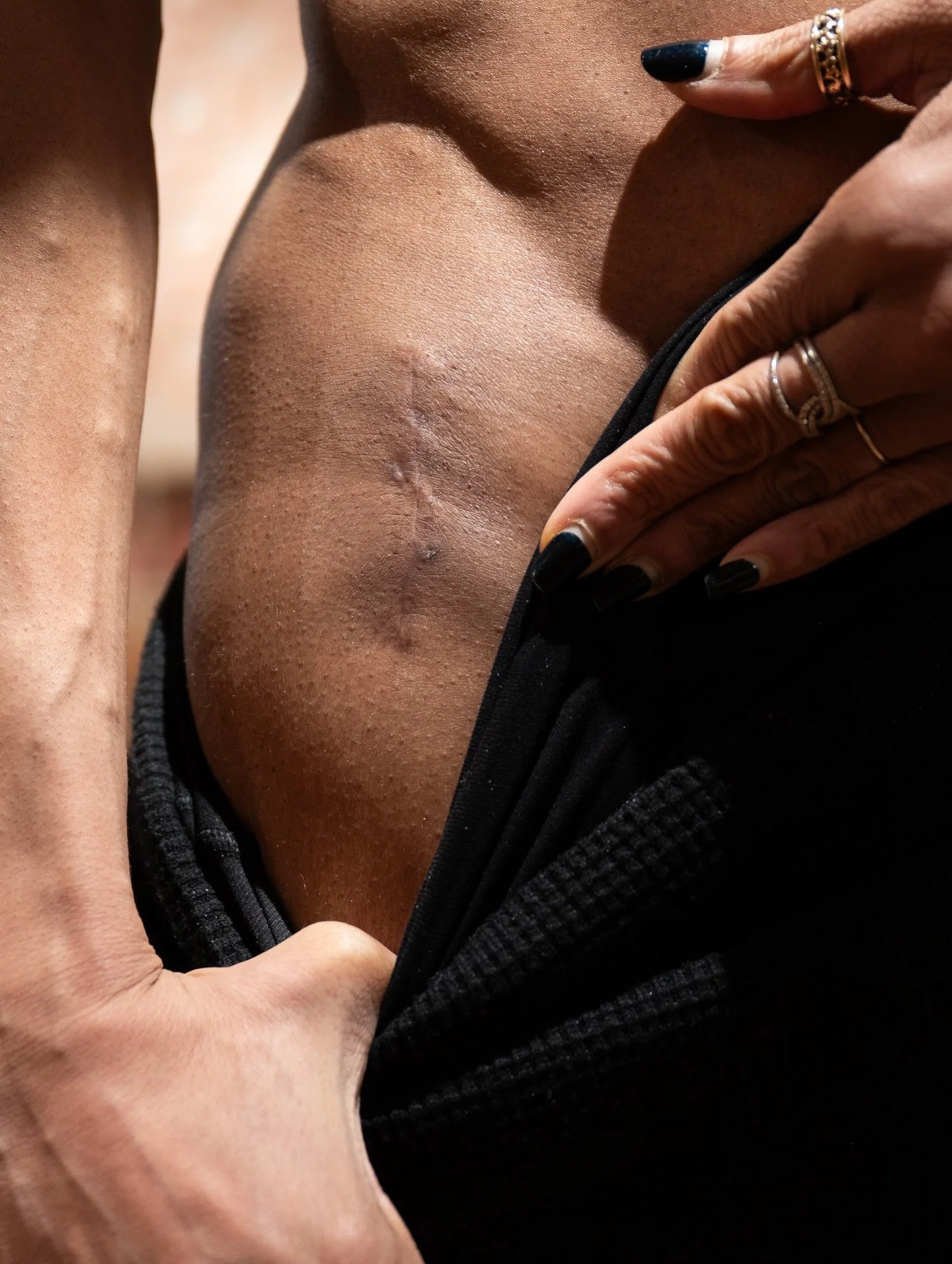 This scar is a single thread woven through the fabric of my story, a quiet yet loud testament to resilience in the face of another surgery and the long arc of healing. I love it not despite the struggle, but because of it&mdash;the way it marks a mom