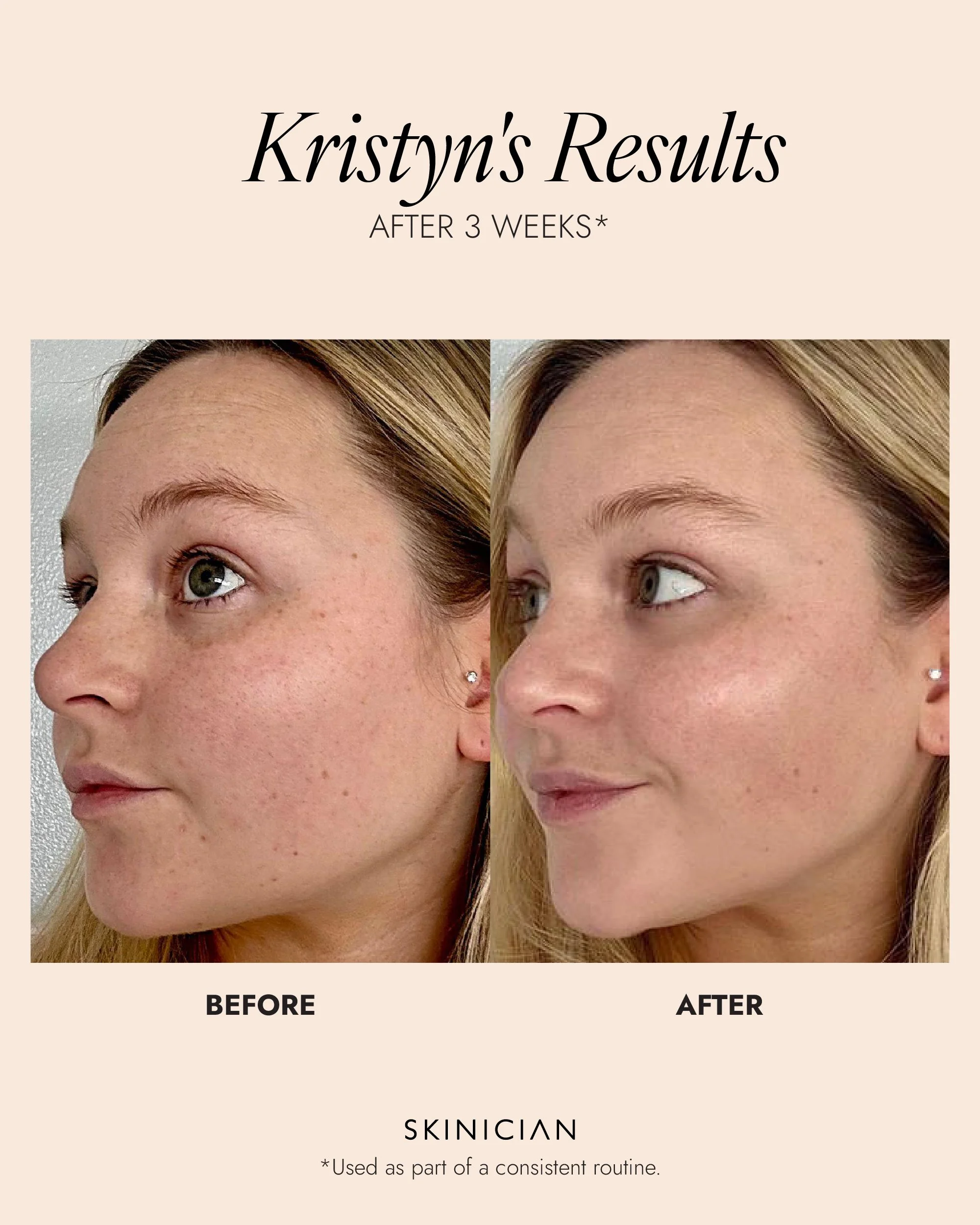 Skinician-Results_Enzyme Cleanser.jpg