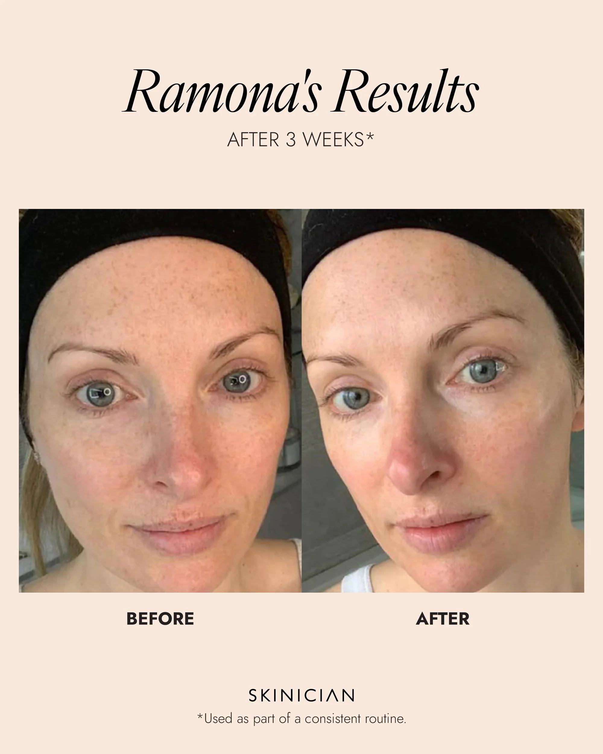 Skinician-Results_Enzyme Peel.jpg