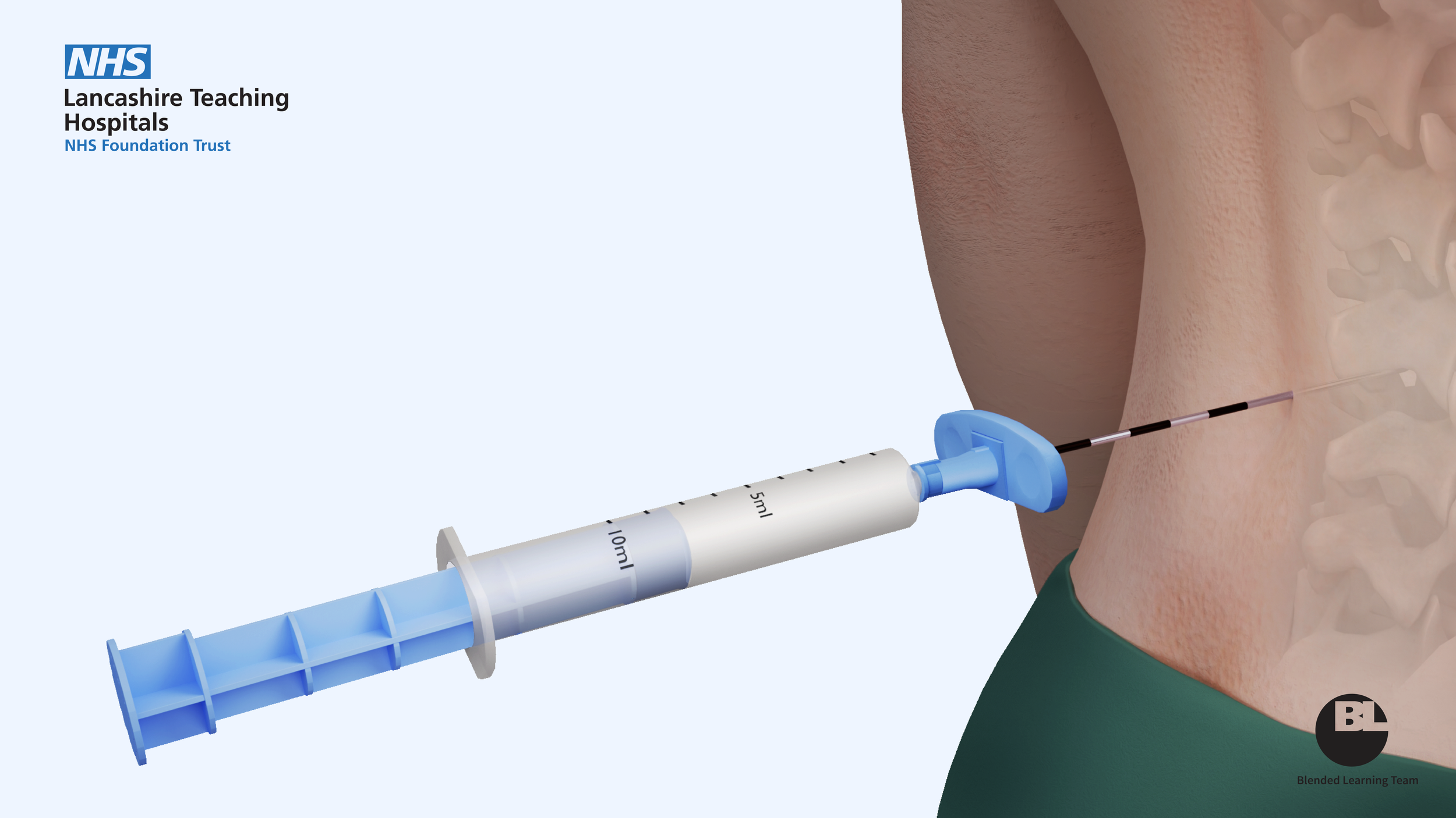 Plastic Blue Barrelled Syringe used with epidural needle for epidural procedures