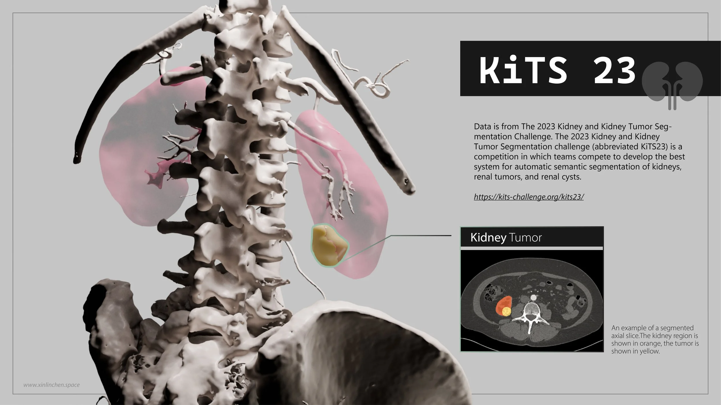 Kidney Tumor - 3D Reconstruction