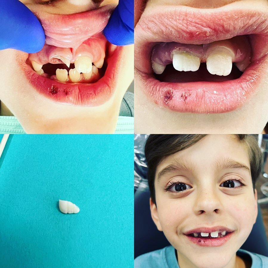 Falls can be nerve-racking (for parents and kiddos)! 

Luckily, this smart Momma found and preserved the fractured portion of tooth. Dr. Kenny was able to work in this sweet family to treat the nerve and reattach the broken piece. 

The only tears sh