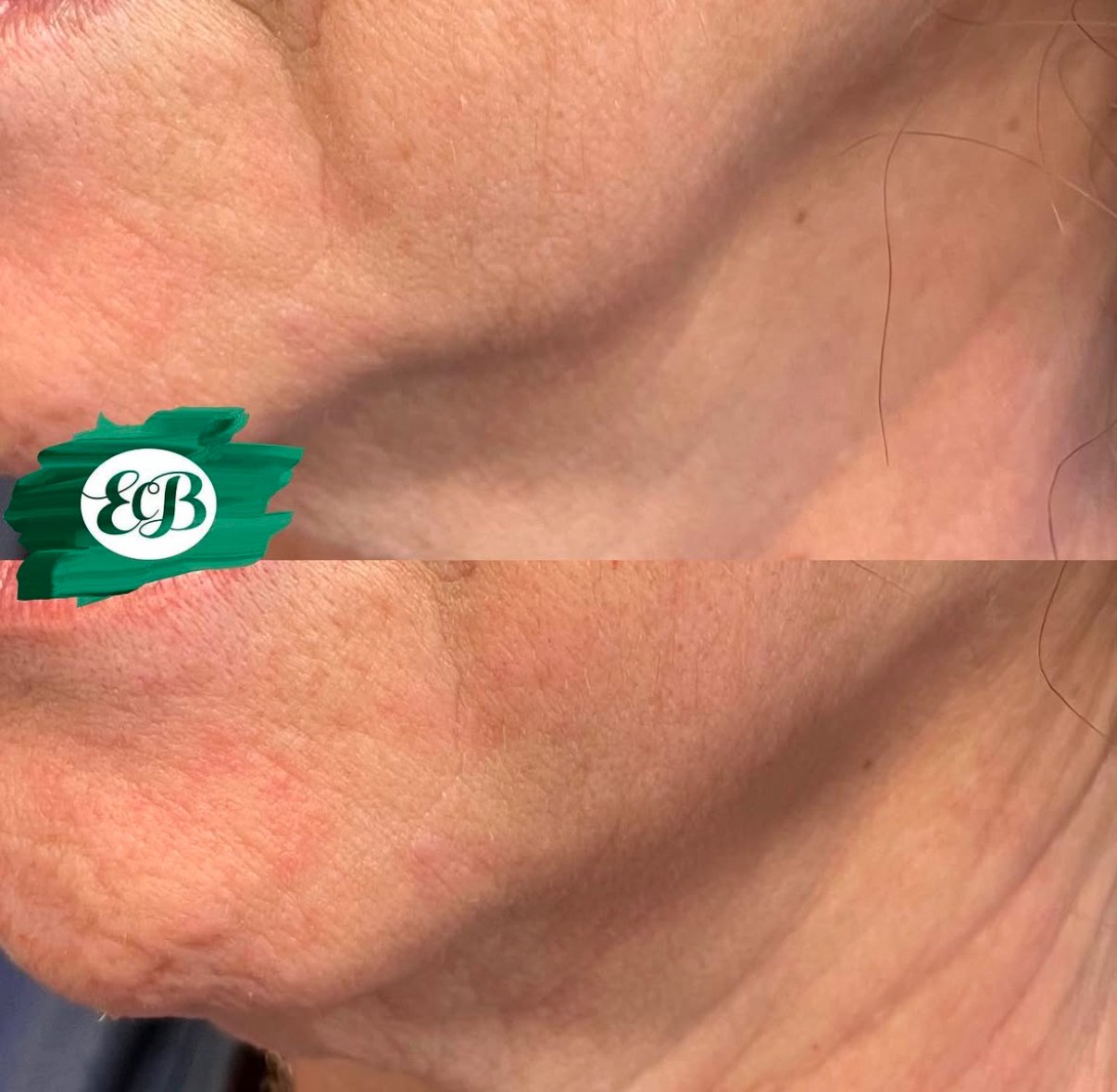 jawline filler 2.jpg