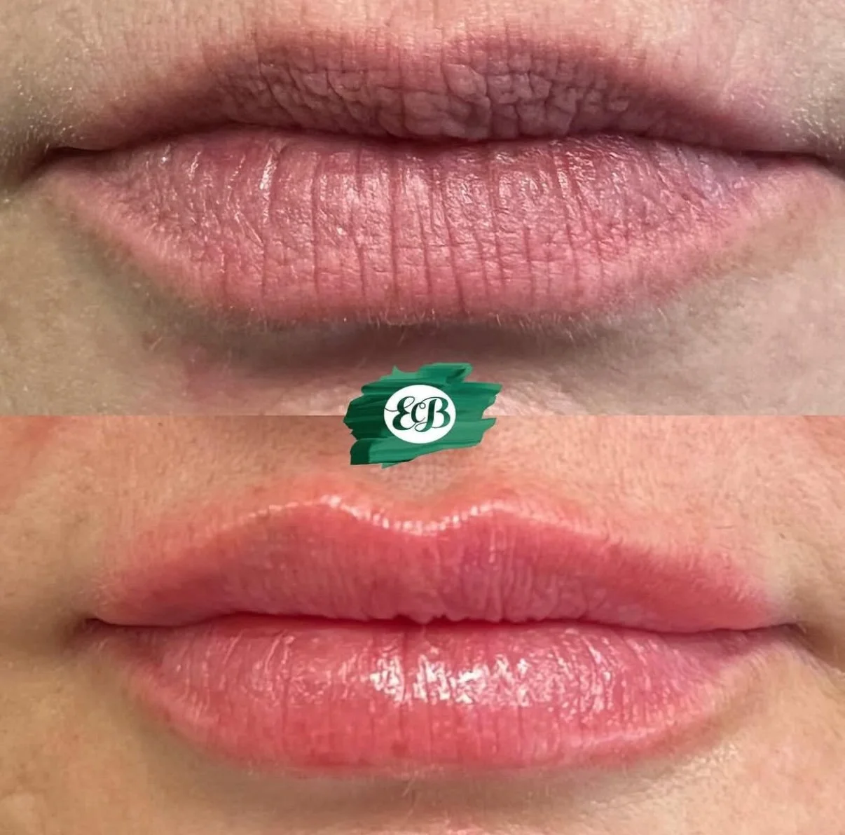 Nikoma Lip filler.jpg