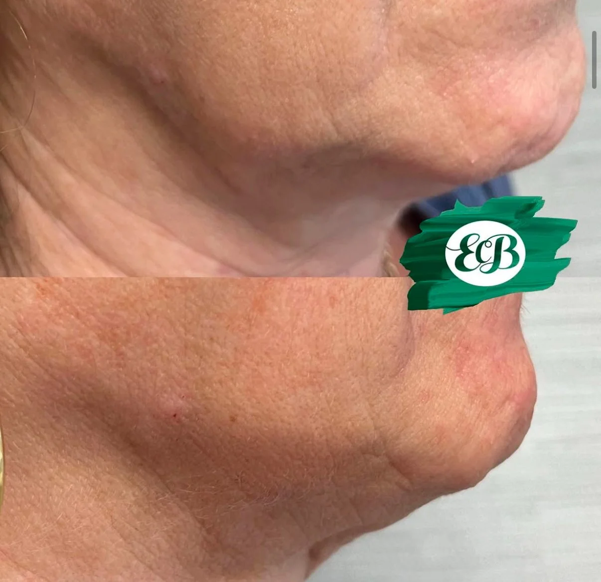 jawline filler 1.jpg
