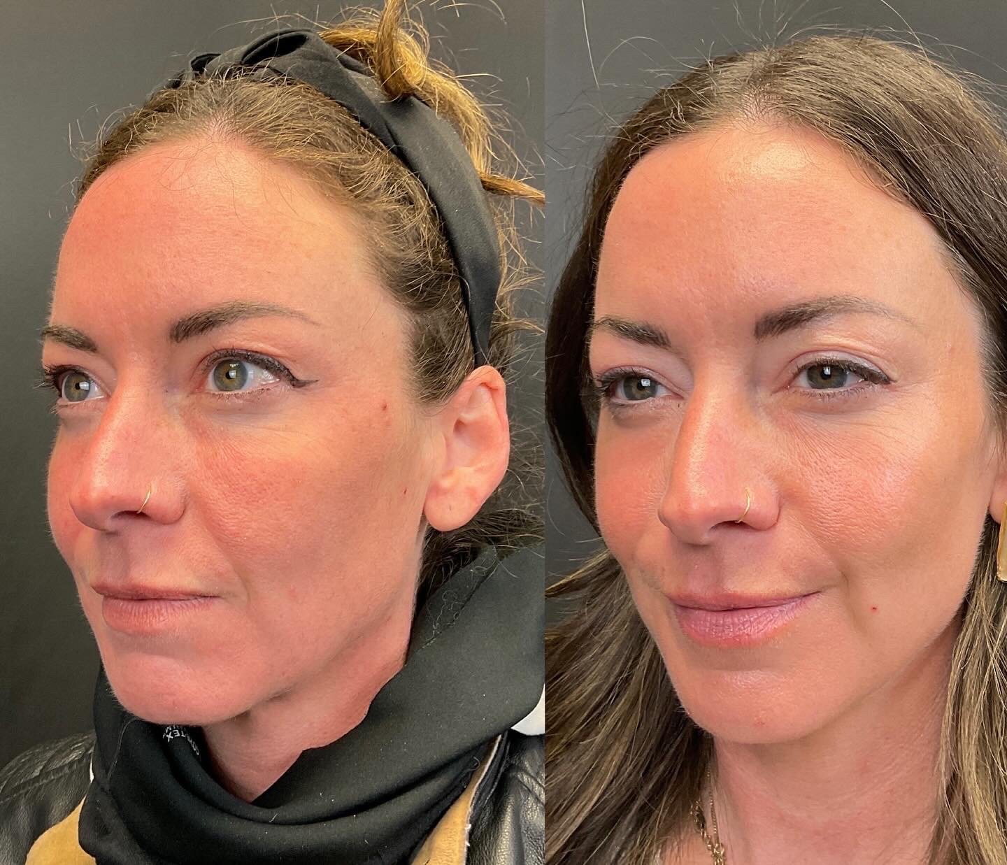 Sculptra 4.jpg