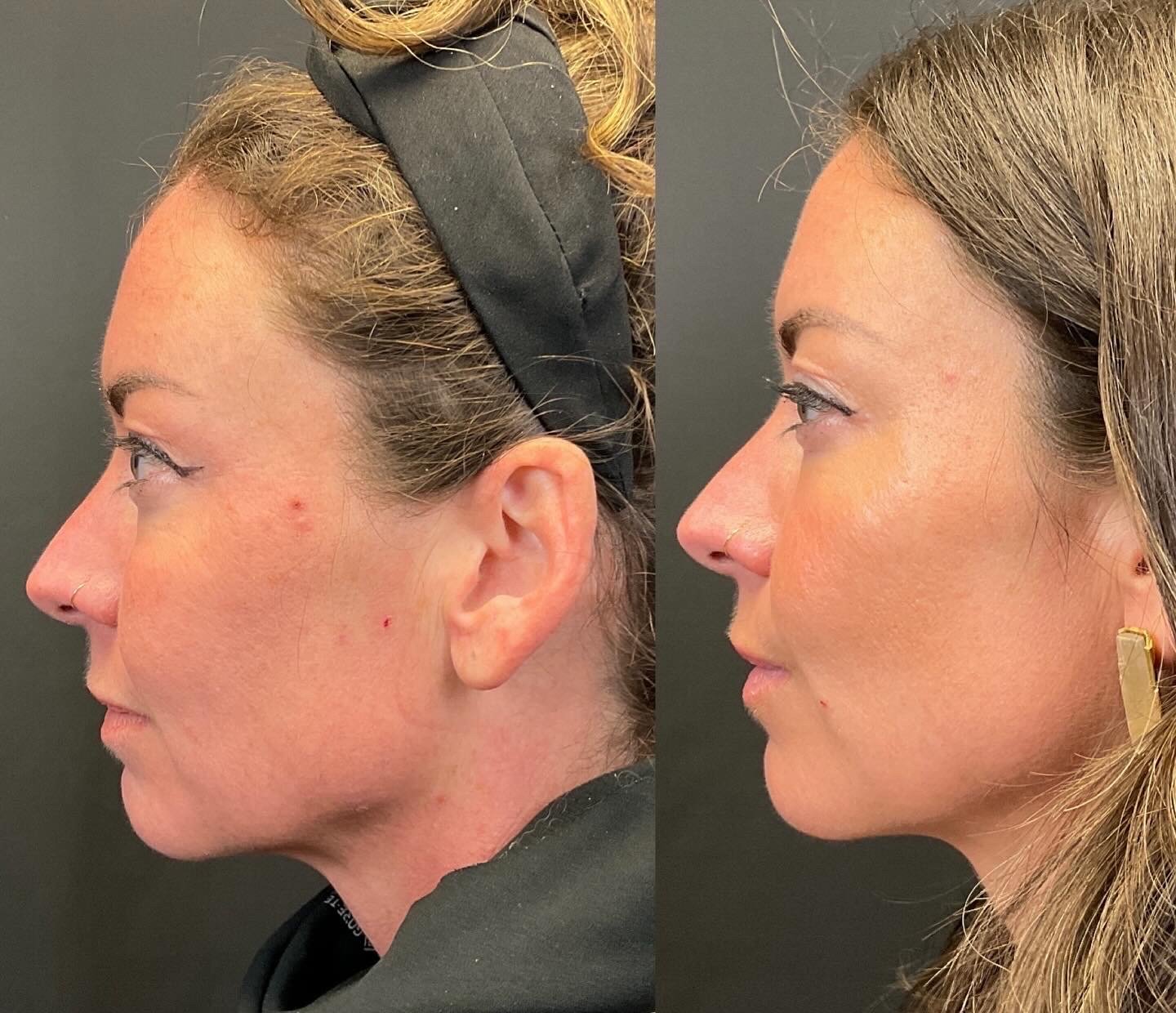 Sculptra 2.jpg