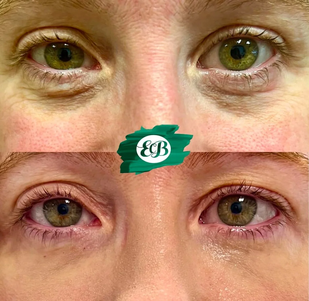 under eye filler 1.jpg