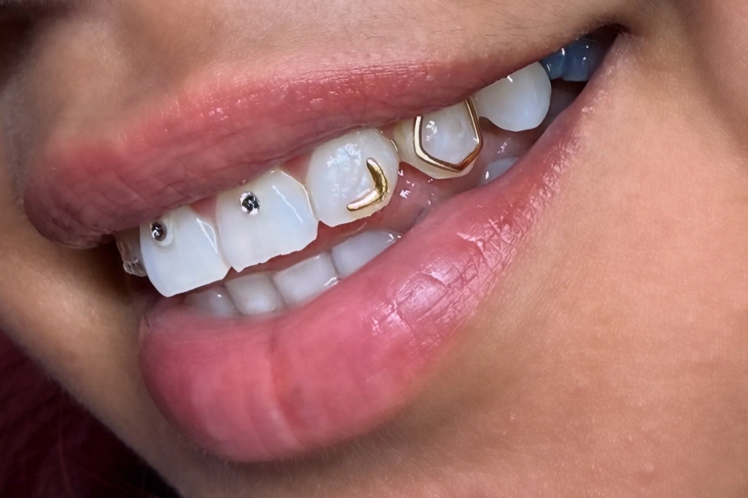 Close-up of a person's mouth showing teeth with dental braces and gold-colored orthodontic spacers.