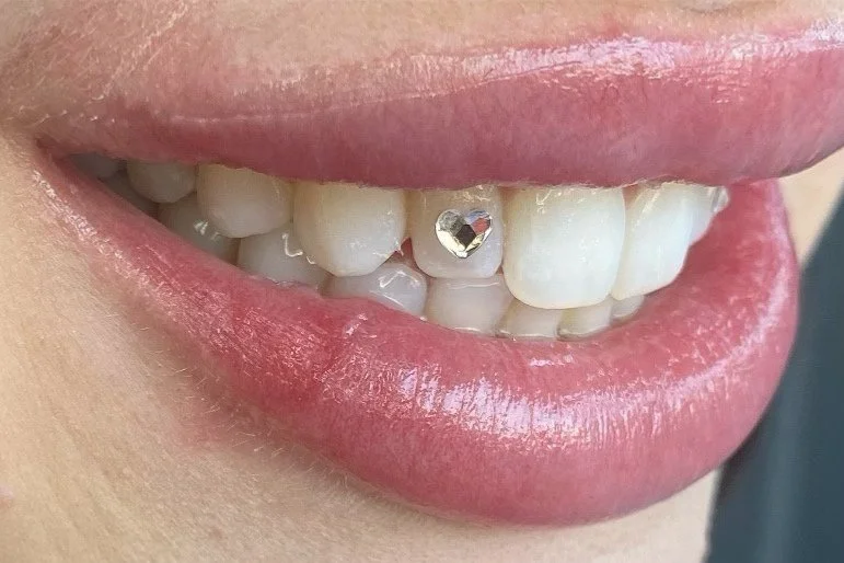 Close-up of a person's smile showing teeth with a small heart-shaped diamond on one tooth.