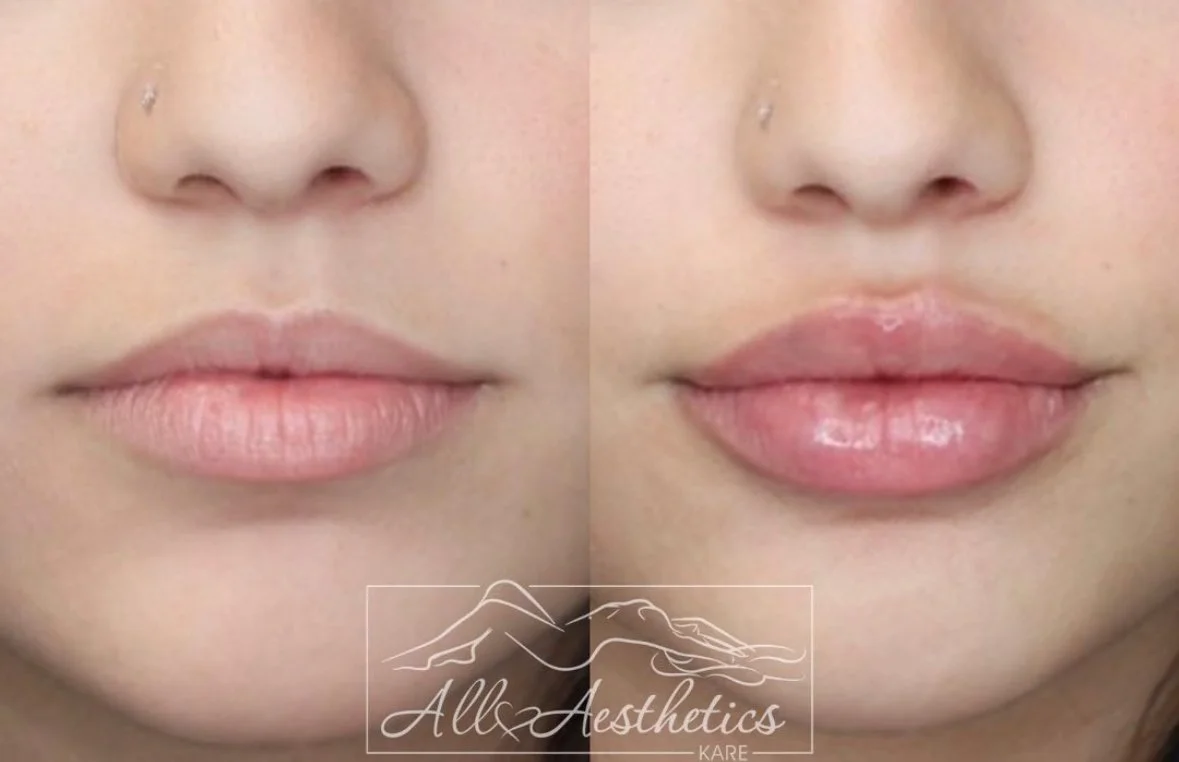 Lip Filler