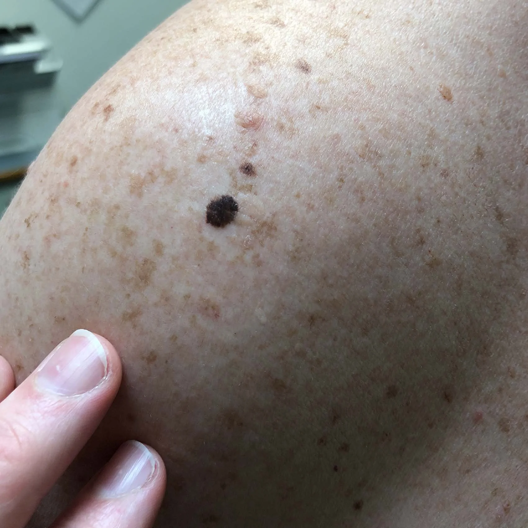 Types of Skin Cancer — The Skin Cancer Centre Coogee