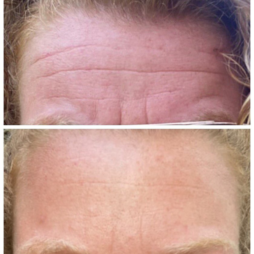 ❓⁉️Are you tired of worrying whether people are staring at the lines in your forehead and face?

🤓 Why do we have these deep lines? 👇🏼
- As we age, we lose the elasticity in our skin therefore, the lines that occur in our skin when makes expressio