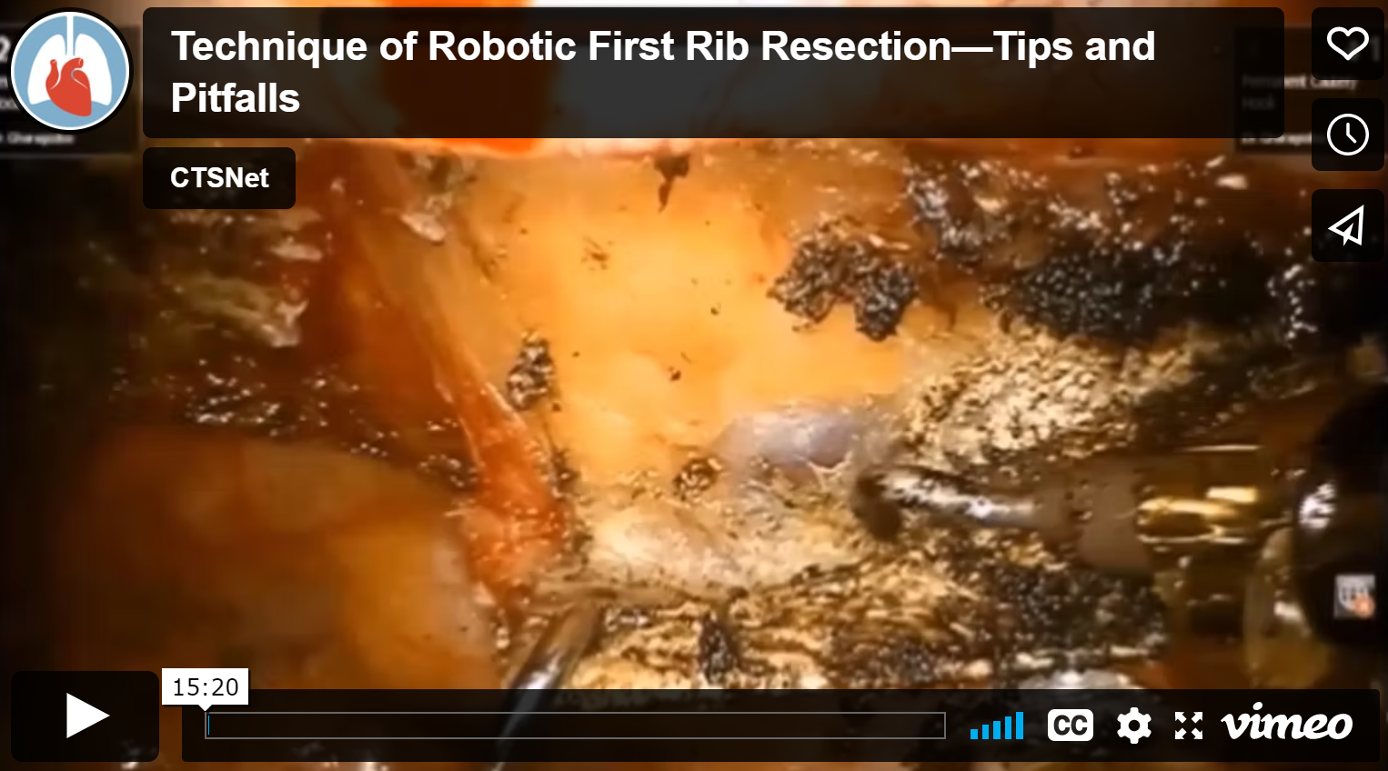 Robotic First Rib Resection For Thoracic Outlet Syndrome — Institute ...
