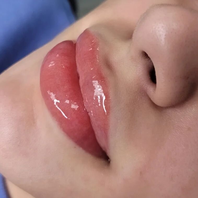 Probably my favorite lip colour! I love the coral warmth to these lips. Her lips were gorgeous to begin with but adding a little colour never hurt nobody 😘

Lips fade in colour when they heal. We choose a colour initially predicting the healed resul