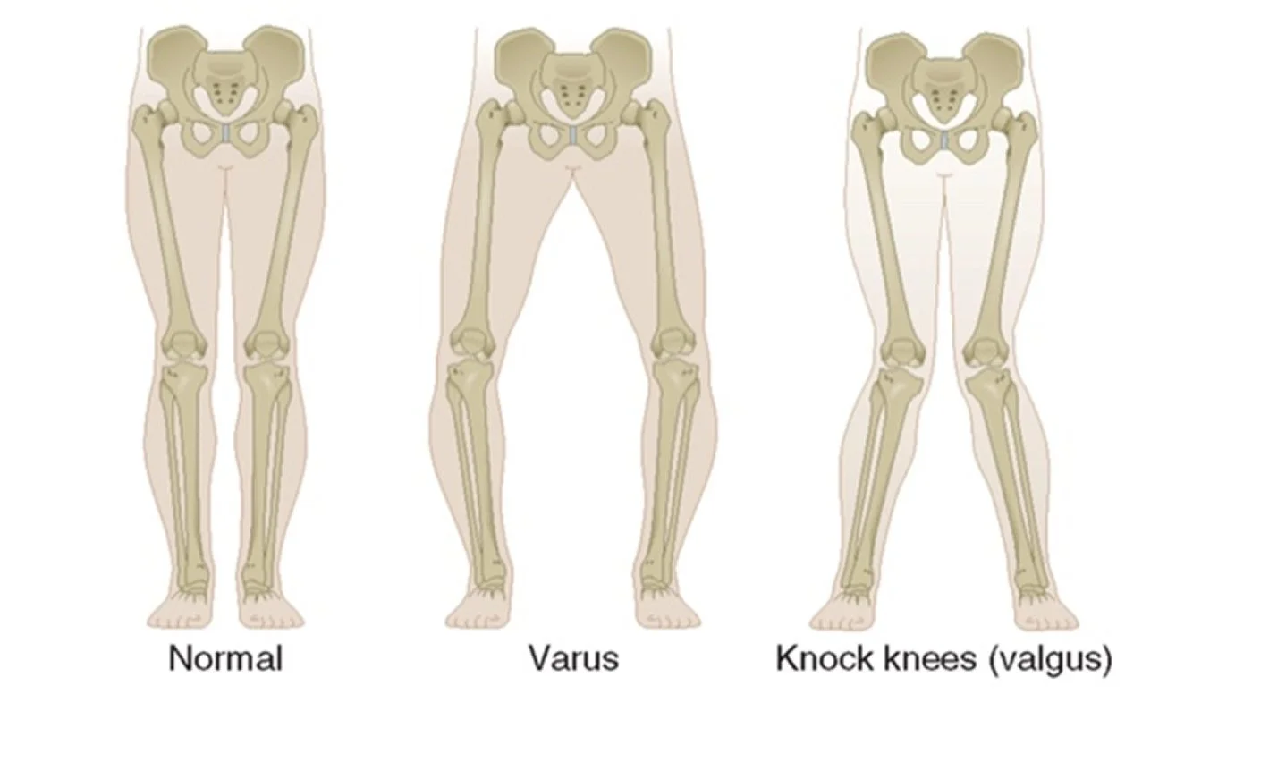 Lower limb alignment