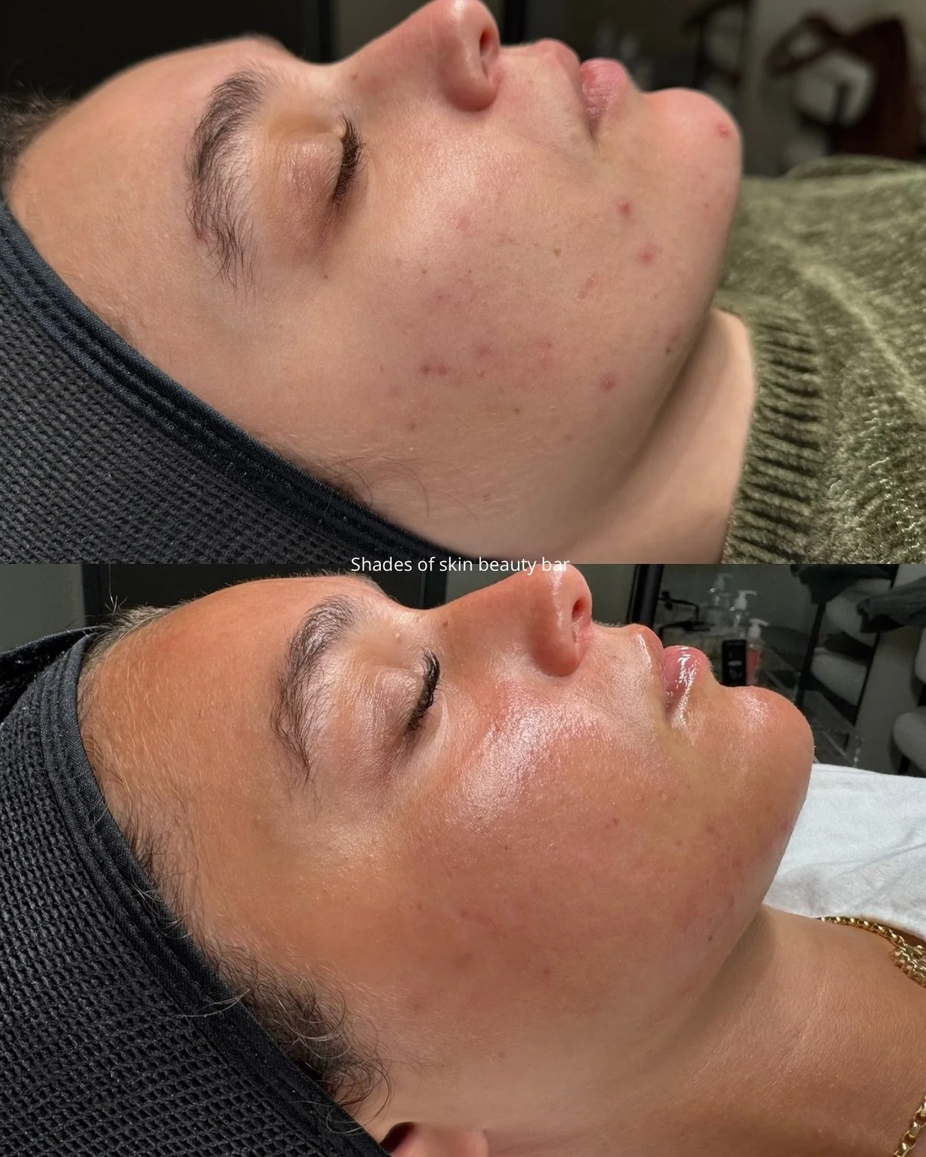 ✨ 6 @aerolase Laser Sessions + 6 custom Peels ✨ She started seeing me a year ago, but still continues to see me to manage her acne &amp; scars. And a moment for the summer tan ! ☀️ (the sun is not evil) 

Your skin tells your story &amp; sometimes, i