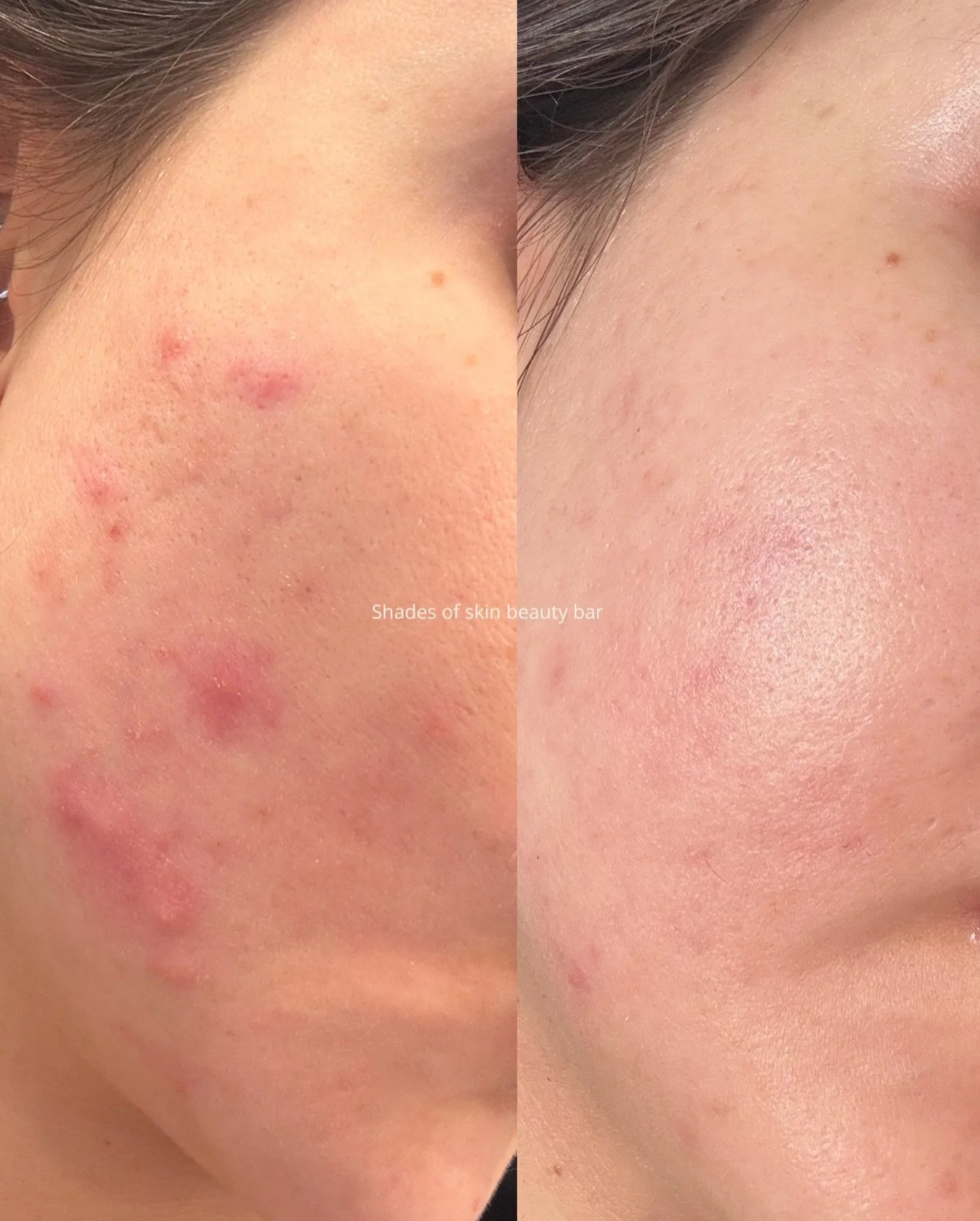 Real talk about acne healing: progress isn't always immediate. 💭 How it started, skin was inflamed, sensitive, &amp; struggling. Like many journeys, there were ups &amp; downs, purges, &amp; stagnant weeks. But every step worked beneath the surface 
