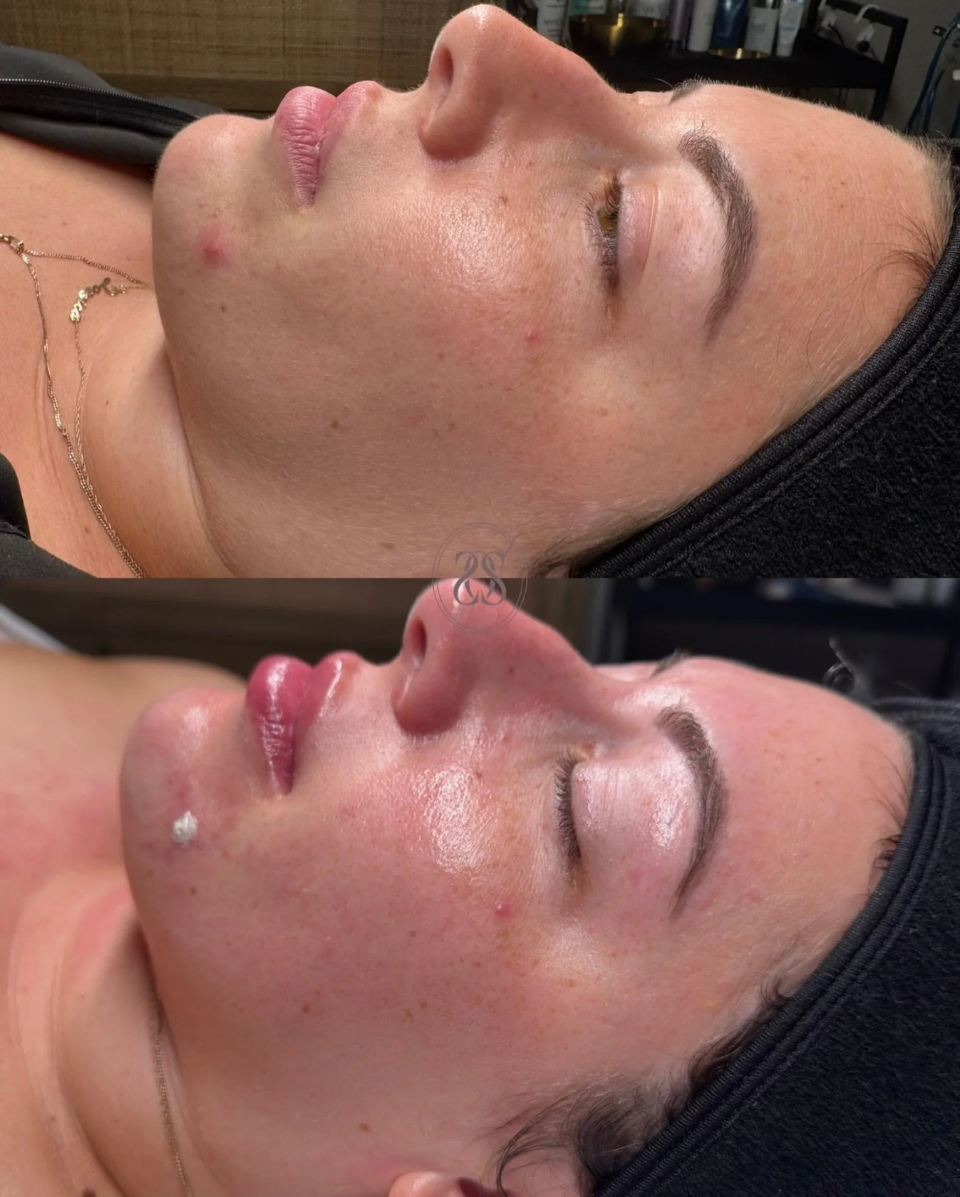 Skin responds best when treatments are chosen intentionally.

This Hydrafacial focused on deep cleansing, hydration, &amp; circulation, preparing the skin for future corrective work while delivering an immediate glow.

Some days the skin needs stimul