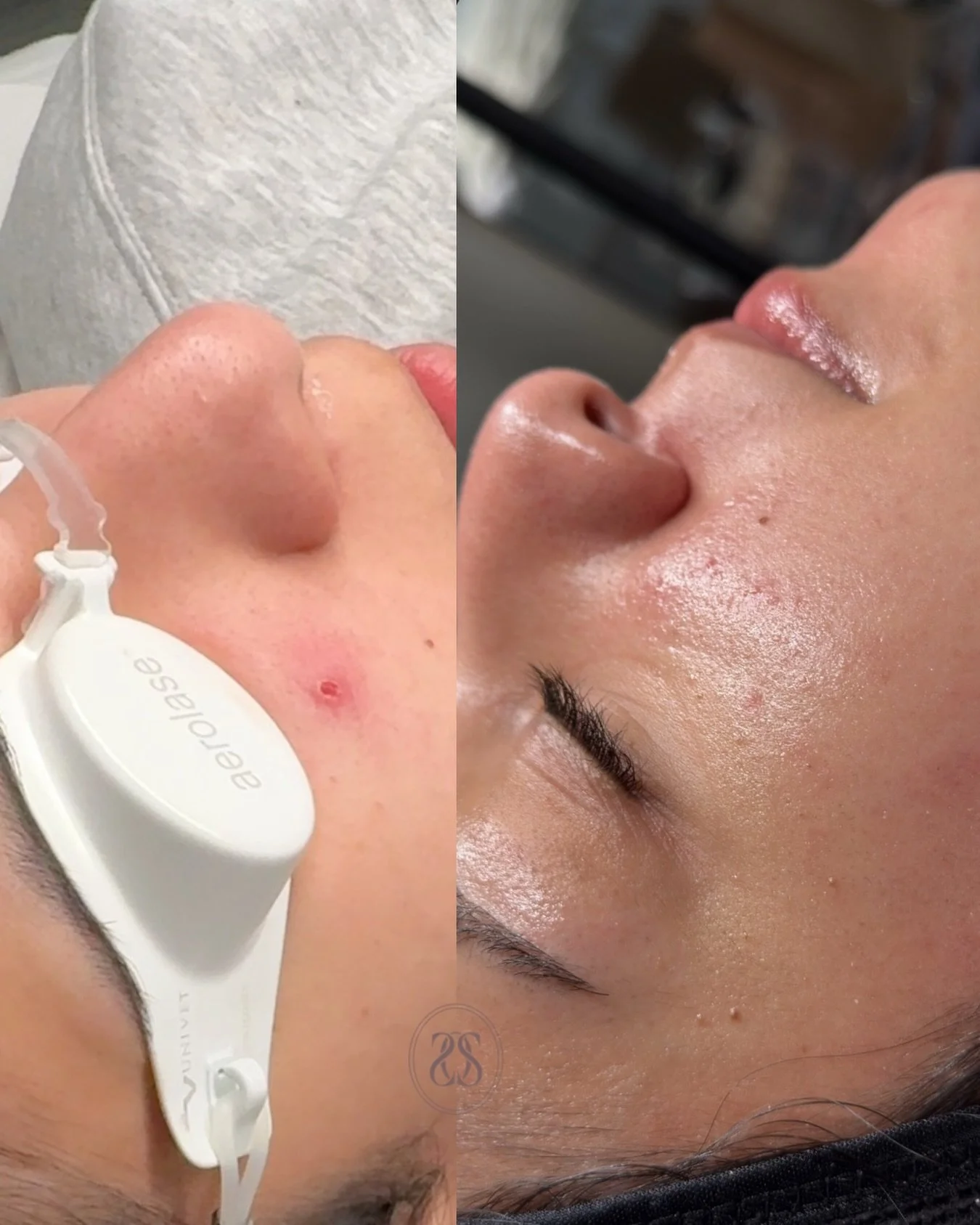 Healing in real time ✨

This before + after was treated with Aerolase &mdash; a gentle laser that helps calm inflammation, speed up healing, &amp; support clearer skin with little to no downtime.

Aerolase can help with:
&bull; Active acne + cystic b