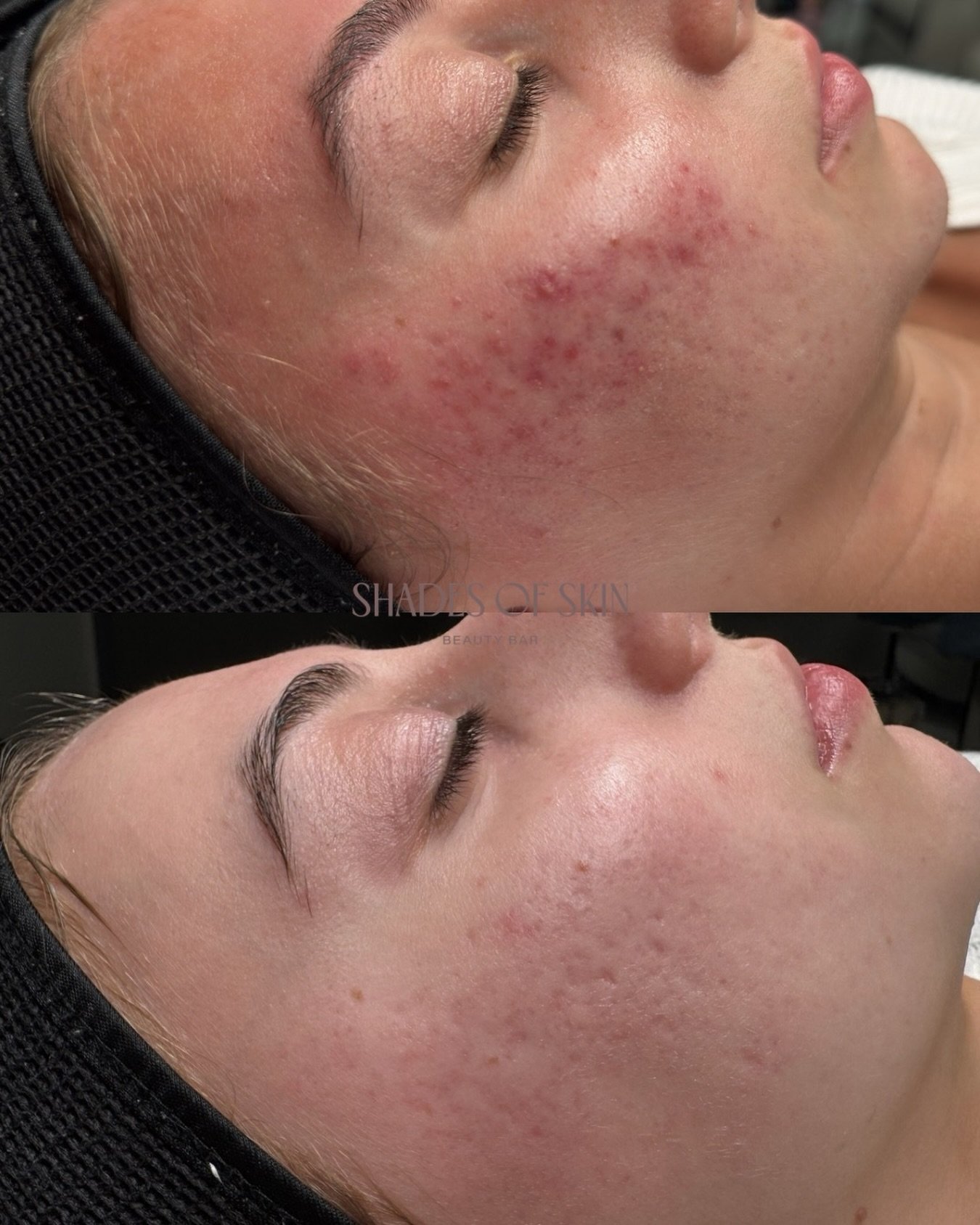 Acne isn&rsquo;t just a phase. It&rsquo;s a skin condition influenced by inflammation, oil production, clogged pores, bacteria, hormones, diet, stress, &amp; even the wrong skincare products.

This is why random TikTok trends &amp; drugstore strippin
