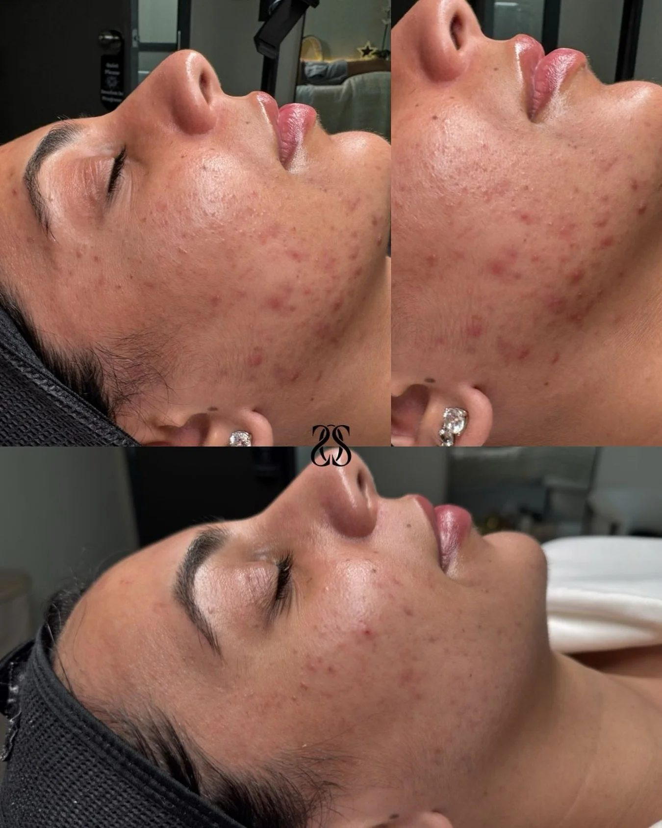 BEFORE VS AFTER 🙏🏼💗🌟Acne is complex&hellip;. &amp; treating it properly takes more than using &ldquo;strong products.&rdquo;

This client received a customized Perfect Derma Peel to target active breakouts, post-inflammatory pigmentation, congest