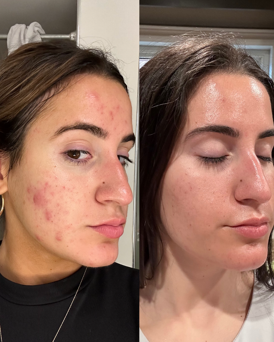Side-by-side comparison of a woman before and after skincare treatment, showing significant reduction in acne and skin clearing.