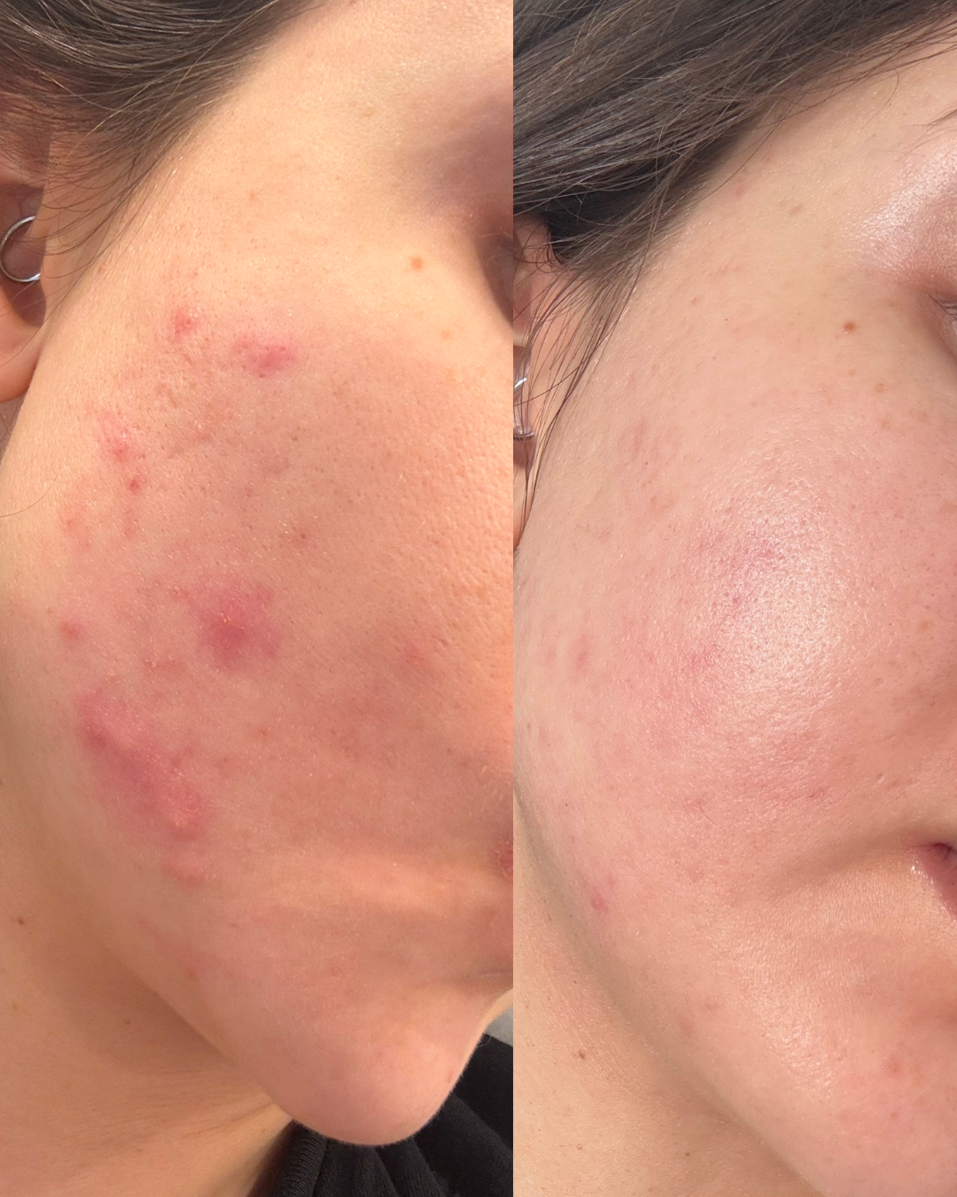 Comparison of skin on a person's cheek before and after treatment, showing reduction in acne and redness.