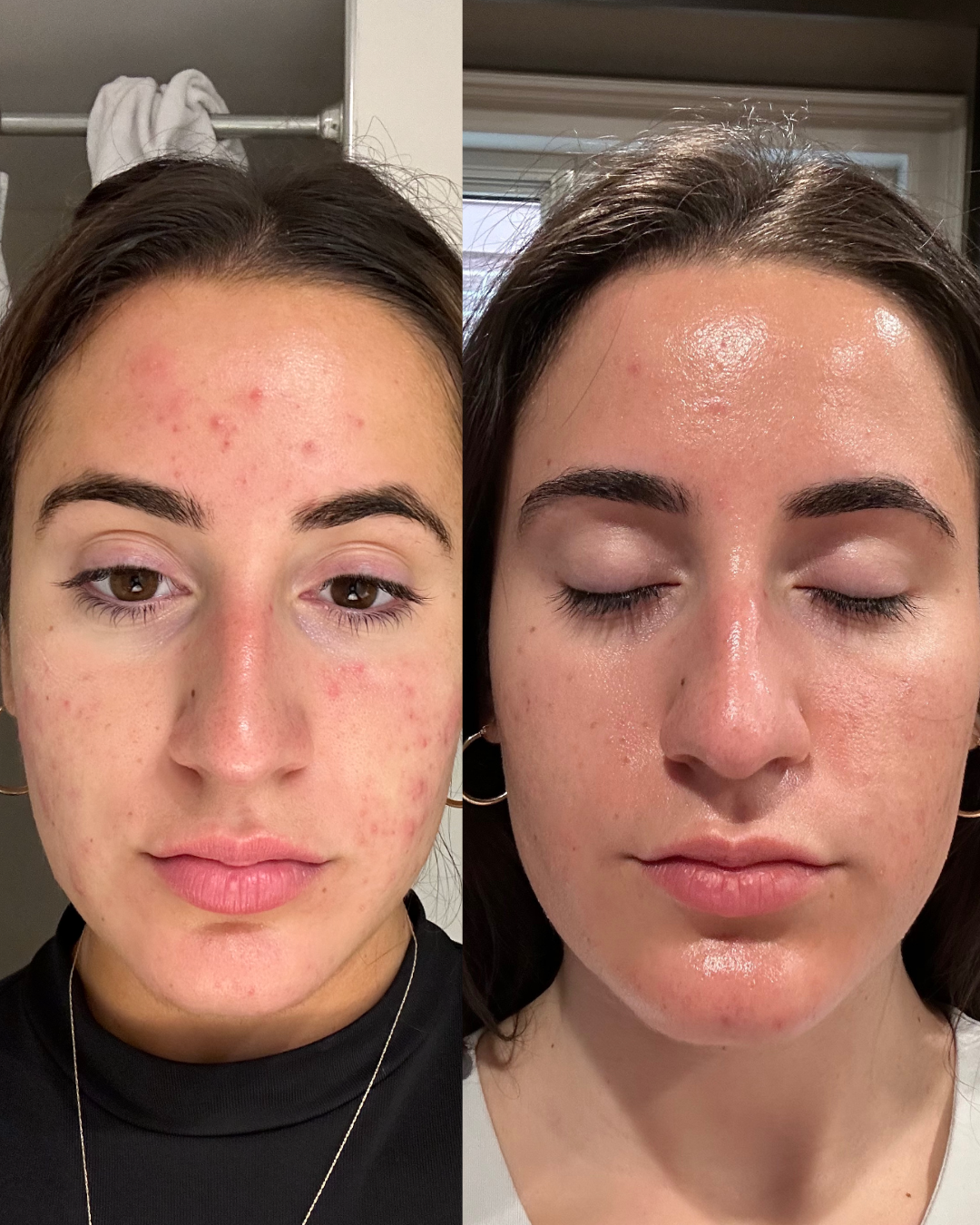 A side-by-side comparison of a woman's face showing before and after skin treatment, with visible reduction in acne and redness.