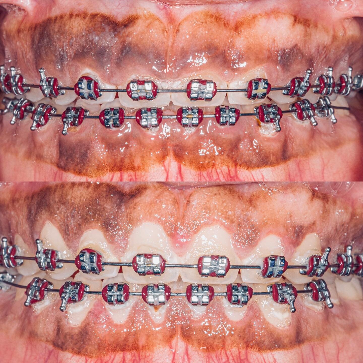 Gingivectomy-3 week post op. 🤩

&ldquo;I can SEE my teeth!&rdquo; 😭😍😁 

Yaayyy&hellip;a VERY happy patient! 💕 

Patient asked if we could remove the melanin pigmentation? 👍🏻. Of course!!! 🤗 next step&hellip;gingivoplasty!

All is healing well