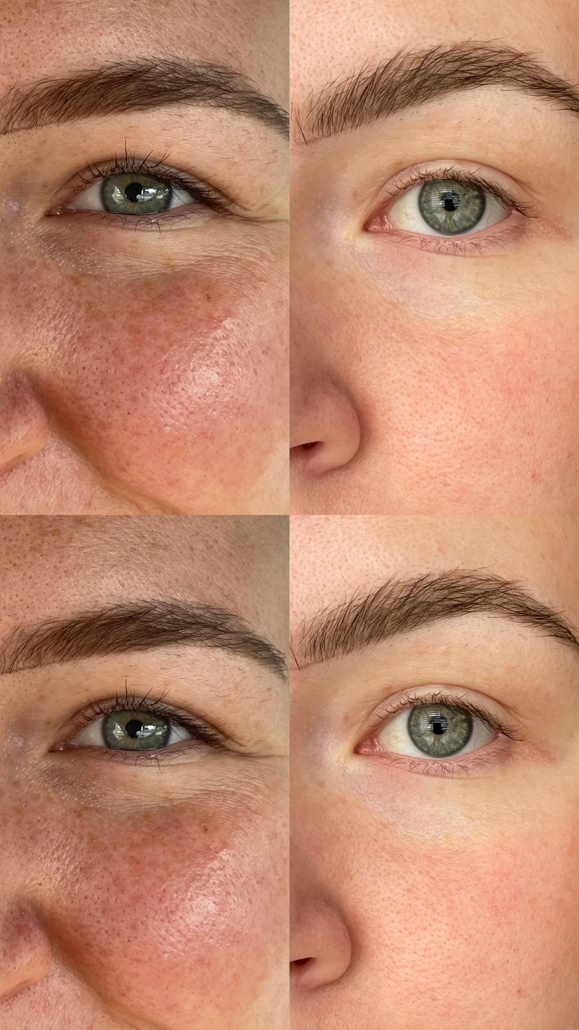 Cool Peel Treatment Refresh Your Skin Safely — The Injection Nurse