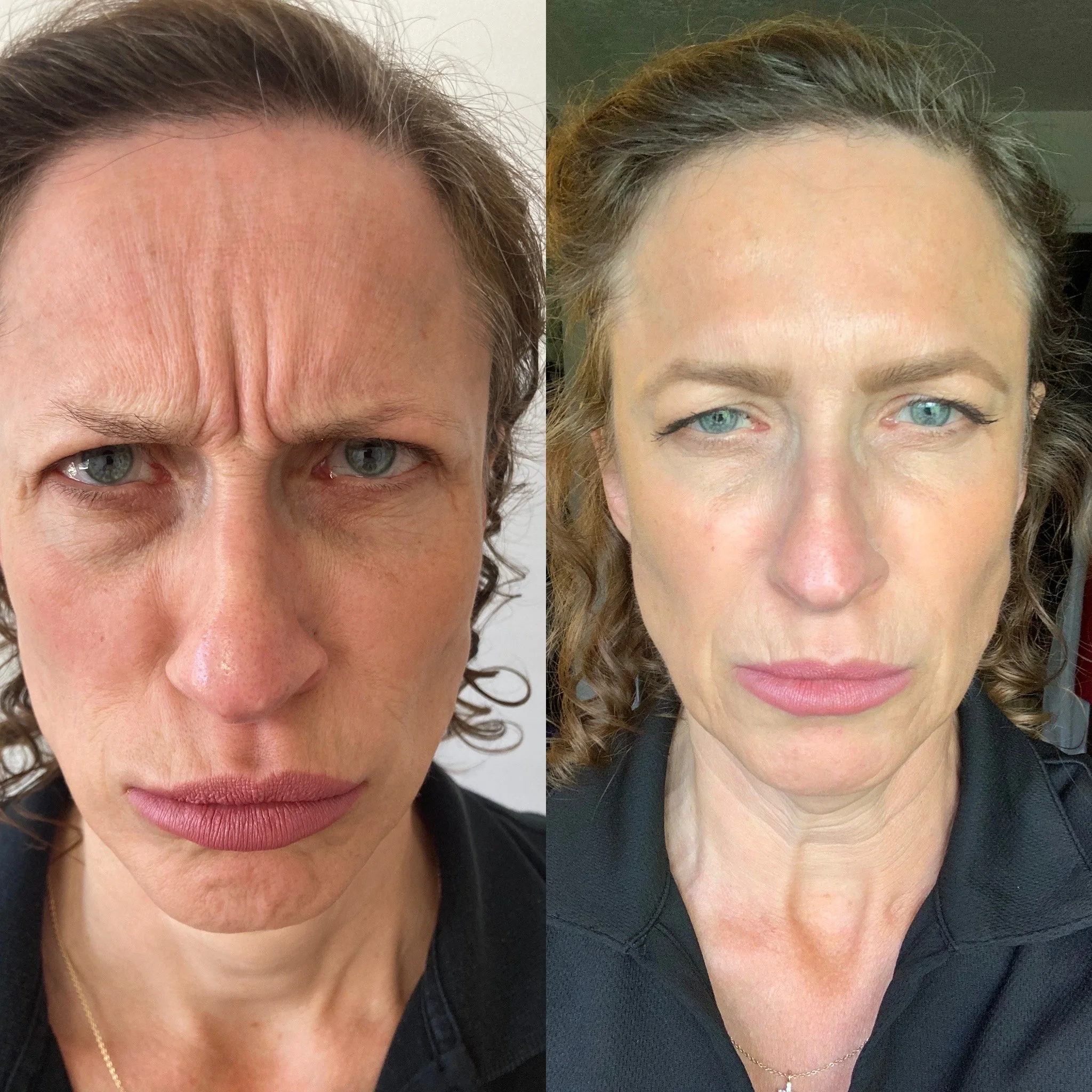 Botox treatment by P.A. Whitney Hunter