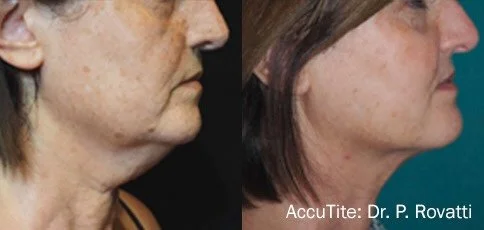 accutite-before-after-dr-p-rovatti-preview-1.jpg