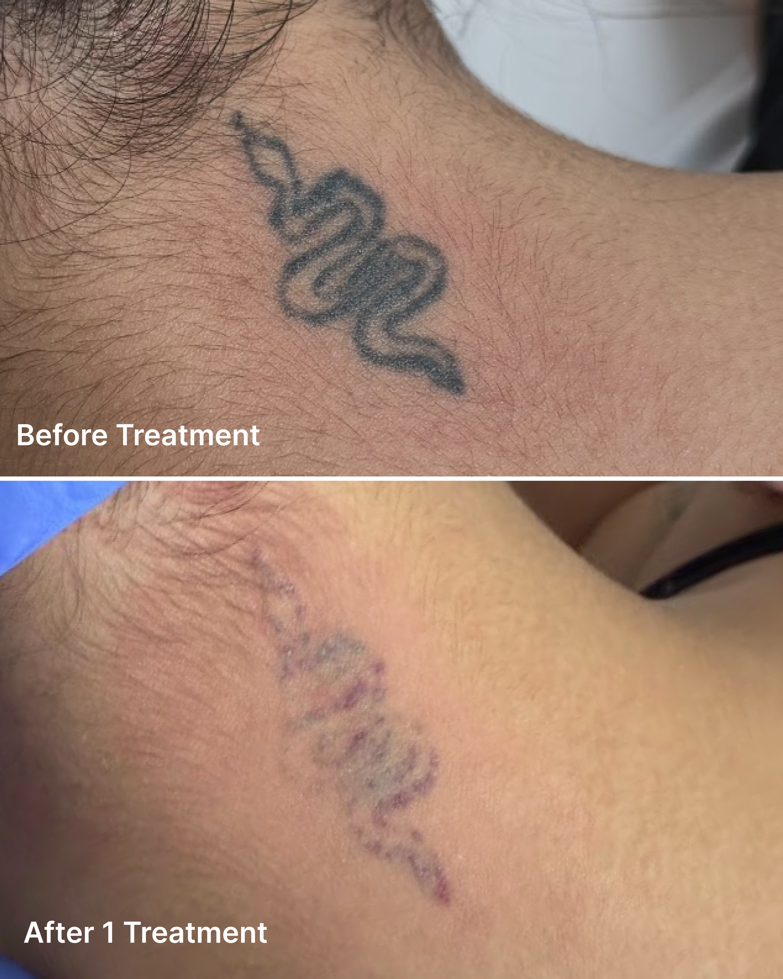 Tattoo Removal