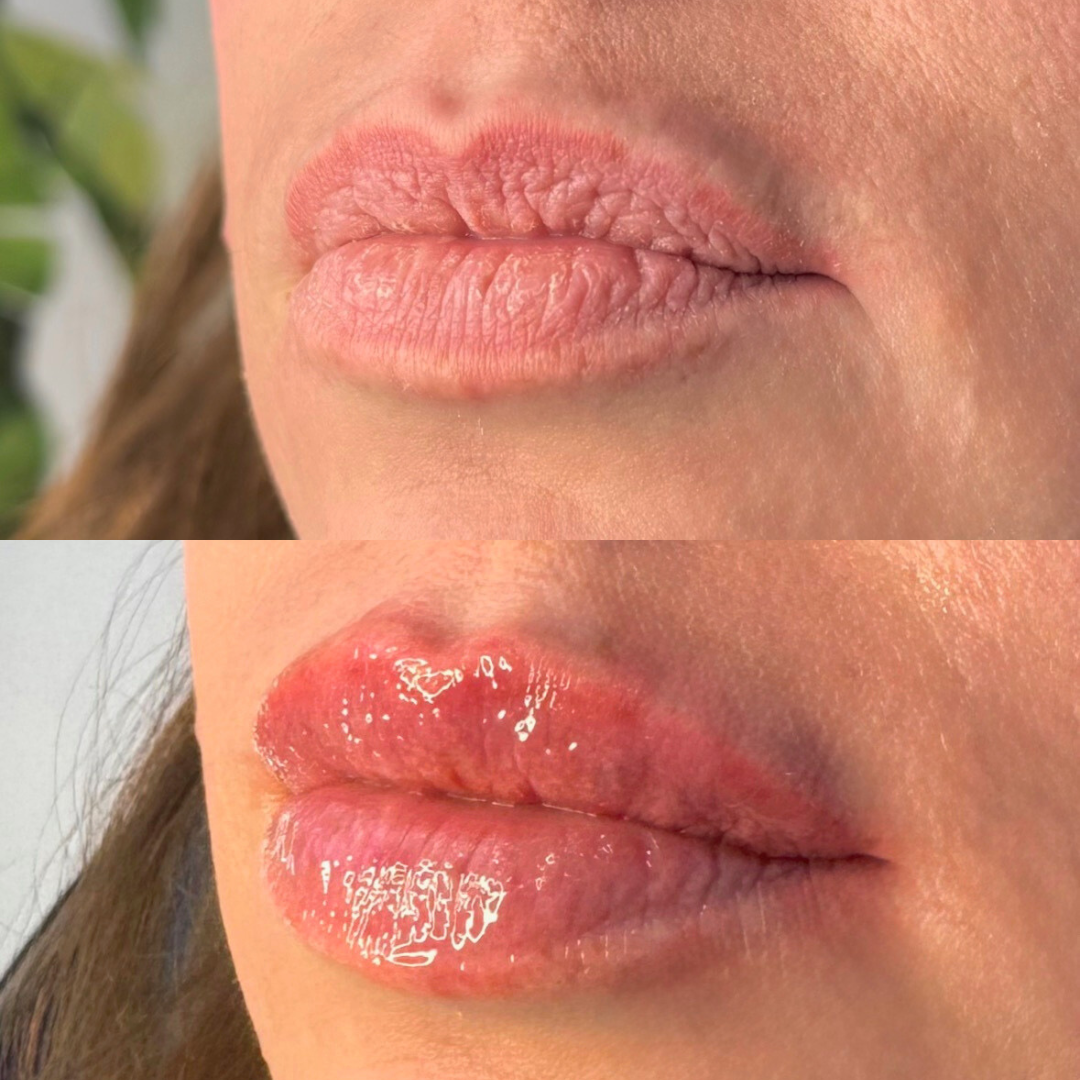 Lip Filler by Nurse Kristy Money