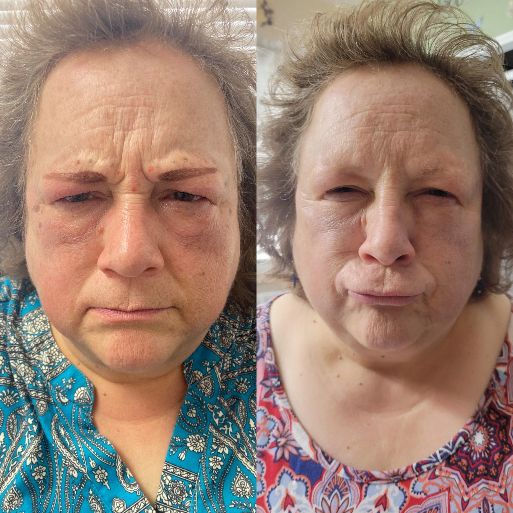 Botox treatment by P.A. Whitney Hunter