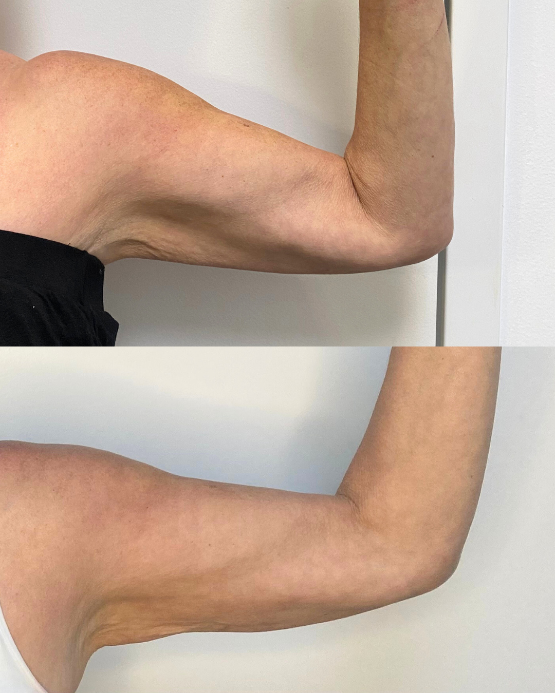 Quantum RF Treatment by Dr. Larsen and P.A. Whitney Hunter