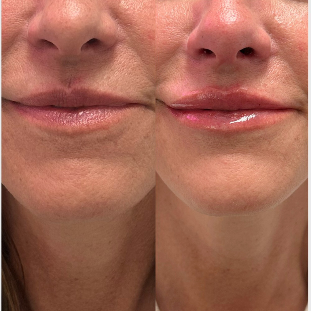 Lip Filler by Nurse Kristy Money
