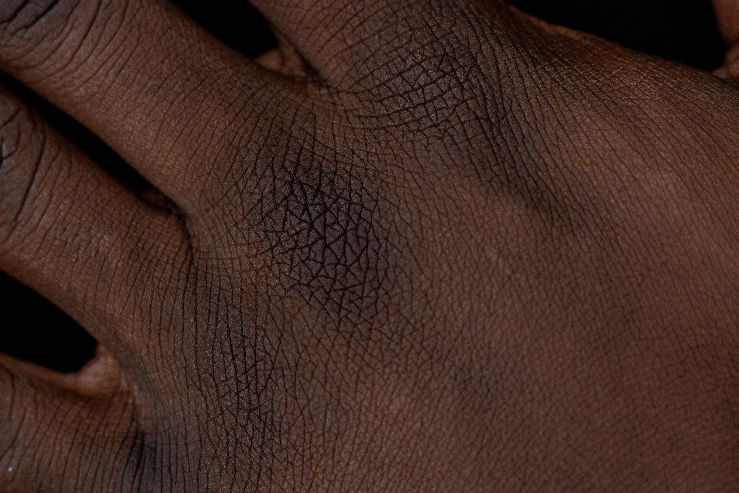 Difference Between Eczema And Psoriasis