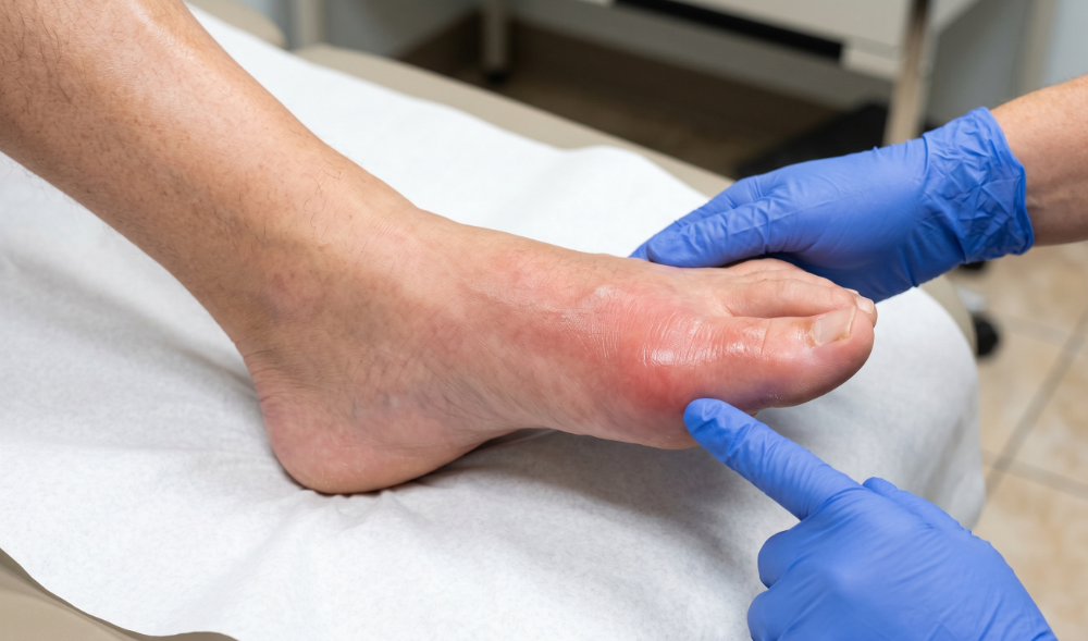 Gout Treatment: A Complete Guide for NP Board Exam Prep